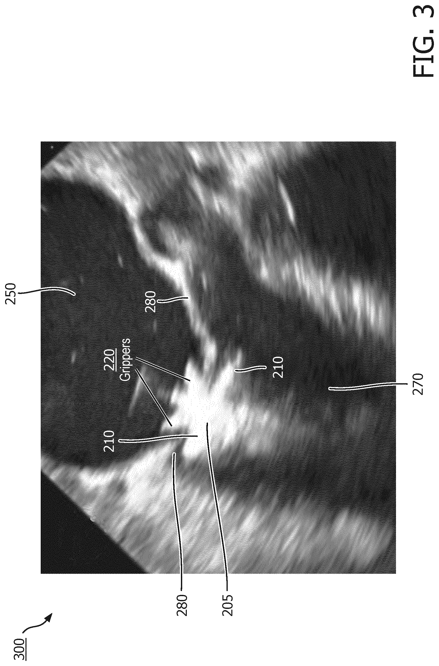 Patent US12327351 Figure 3 – Medical imaging systems, devices, and methods for visualizing a deployment state of an intracorporeal therapeutic device