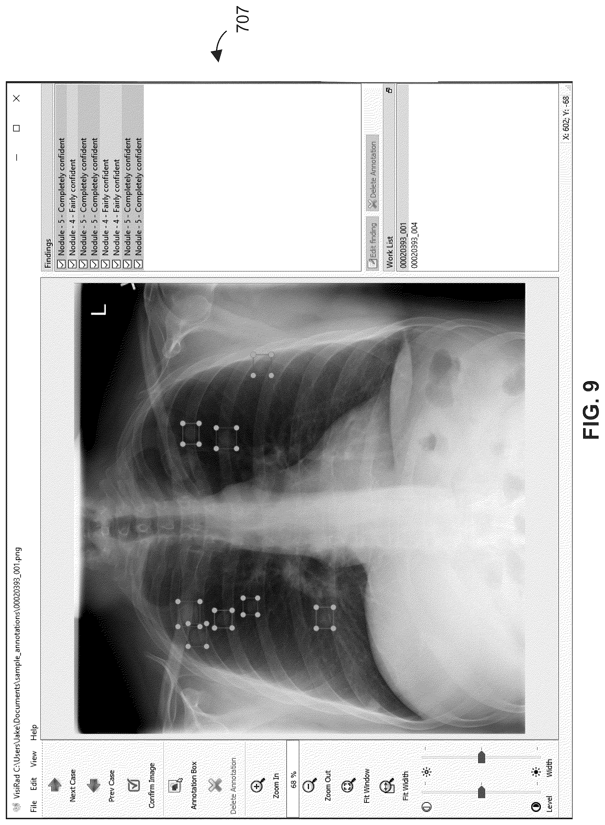 Patent US12327356 Figure 13 – Methods of assessing lung disease in chest X-rays
