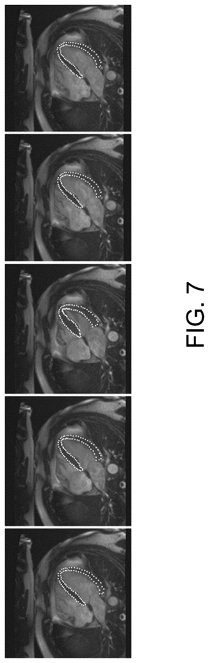 Patent US12327359 Figure 7 – Image segmentation and tracking based on statistical shape model