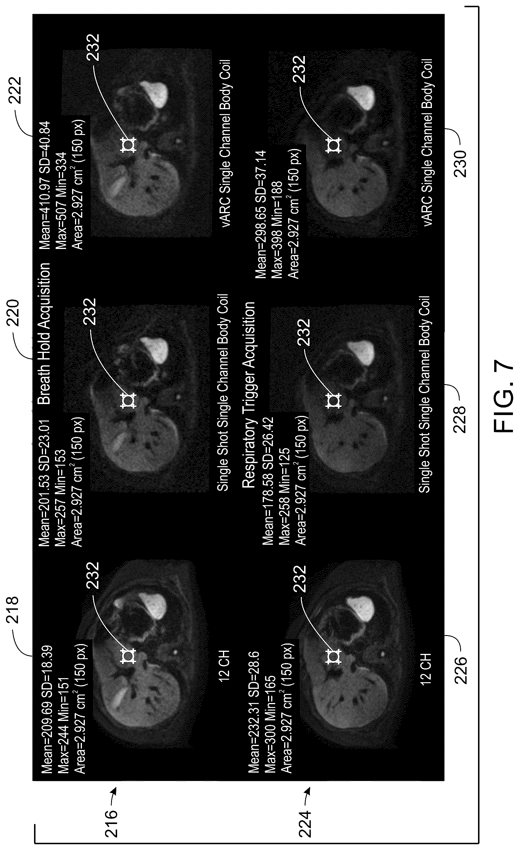 Patent US12332334 Figure 5 – System and method for multi-shot variable auto-calibrating reconstruction for single channel diffusion weighted magnetic resonance imaging using low rank