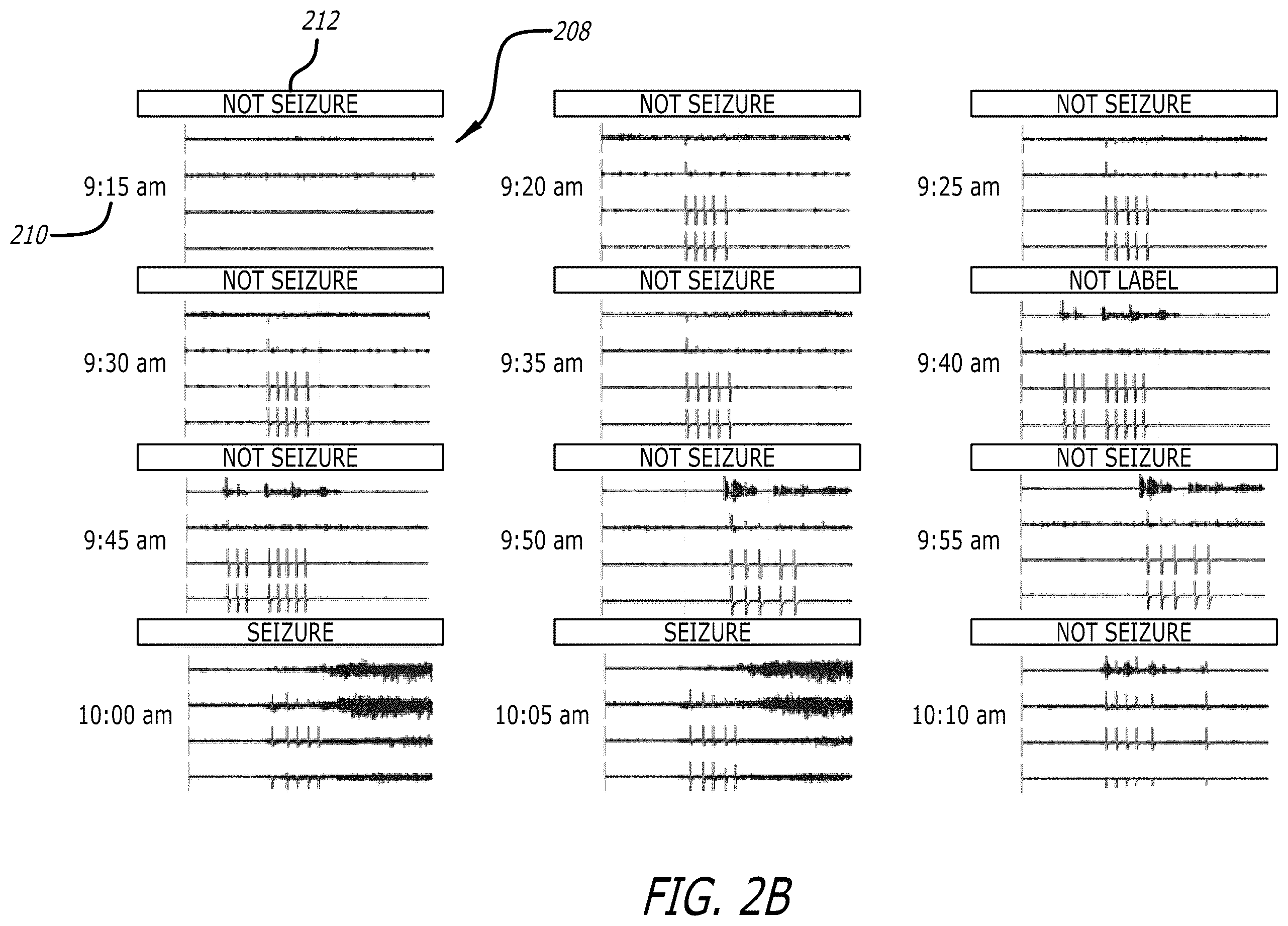 Patent US12333443 Figure 3 – Systems and methods for using federated learning for training centralized seizure detection and prediction models on decentralized datasets