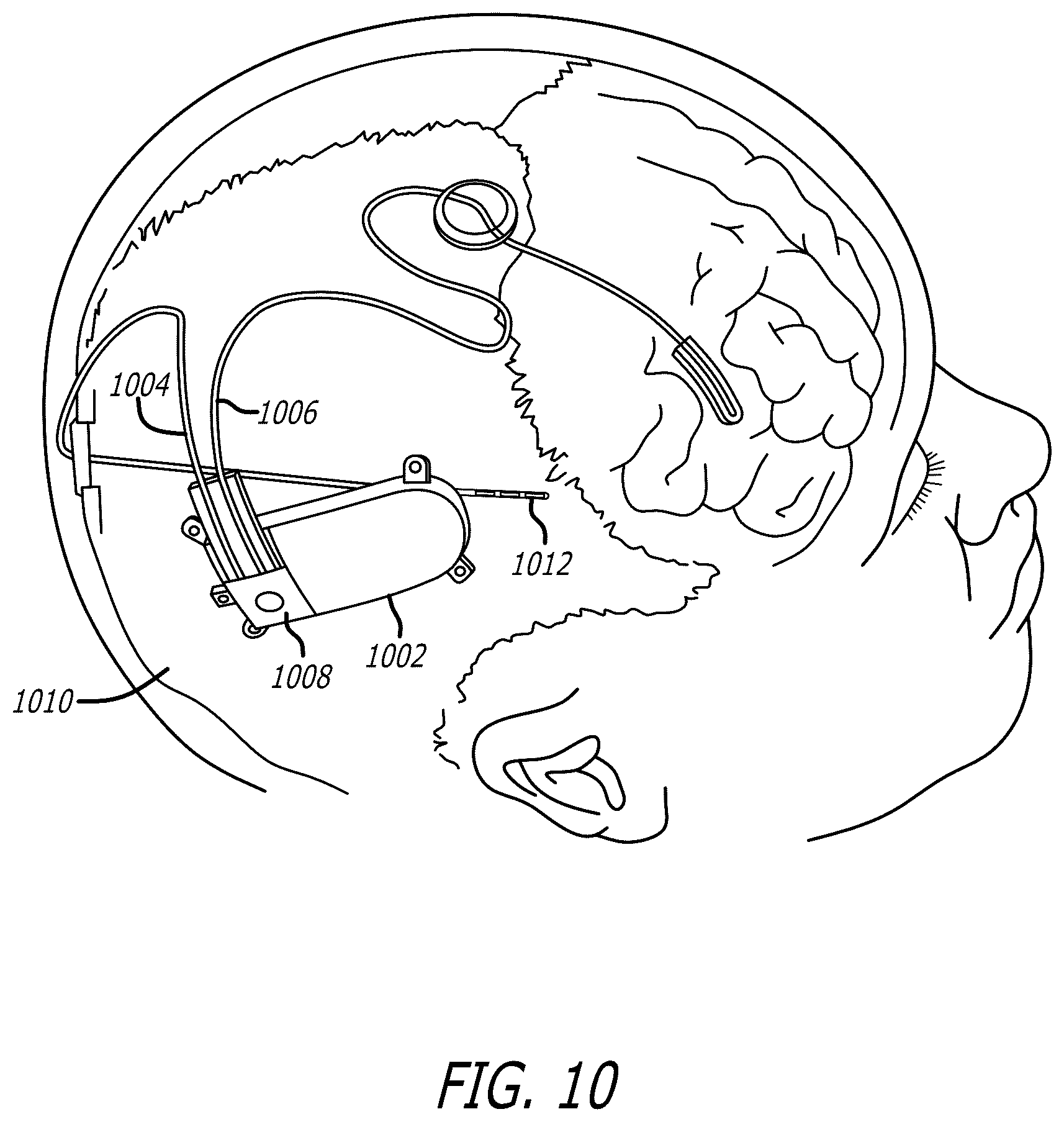 Patent US12333443 Figure 14 – Systems and methods for using federated learning for training centralized seizure detection and prediction models on decentralized datasets