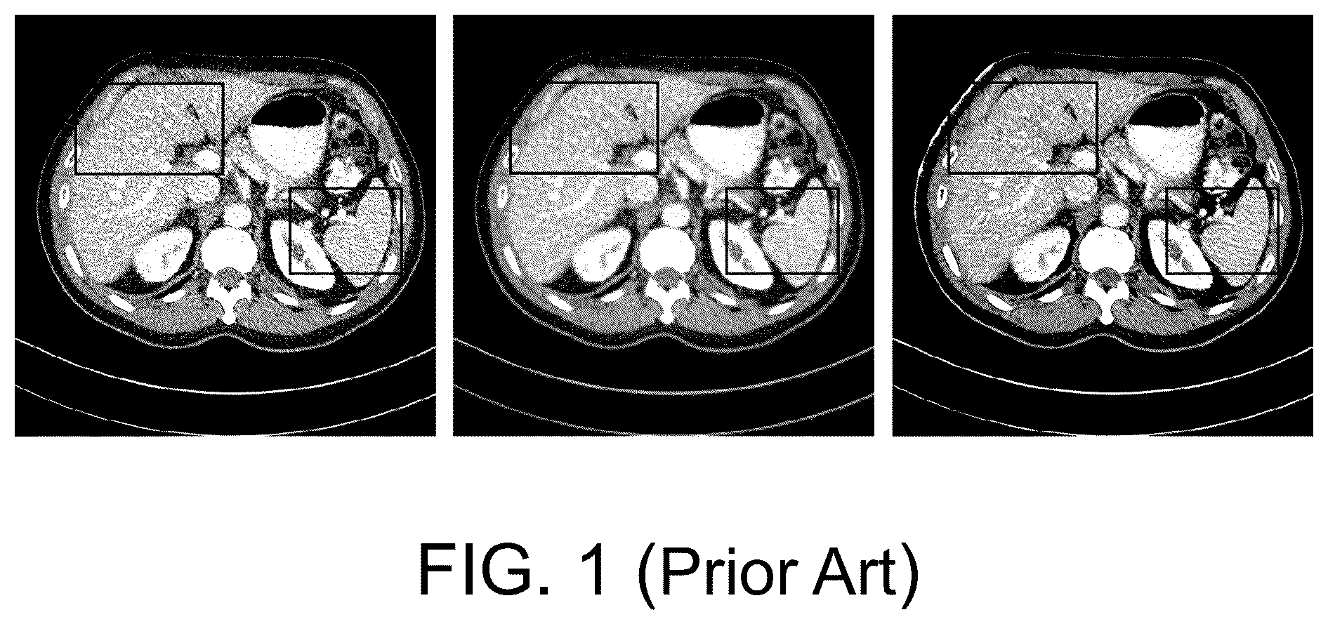 Patent US12333686 — Zero-shot low-dose CT image denoising method and apparatus based on strip diffusion model — Figure 1