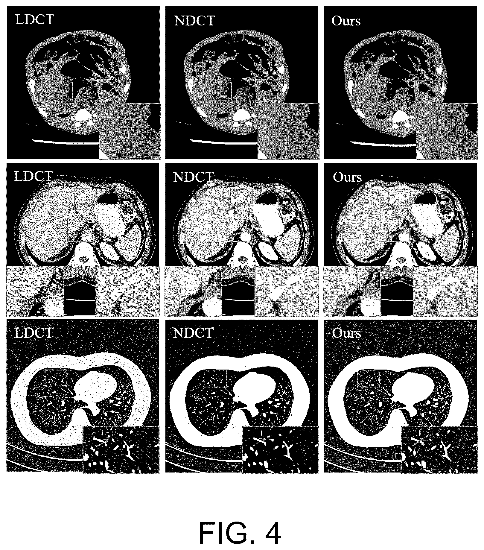 Patent US12333686 Figure 3 – Zero-shot low-dose CT image denoising method and apparatus based on strip diffusion model