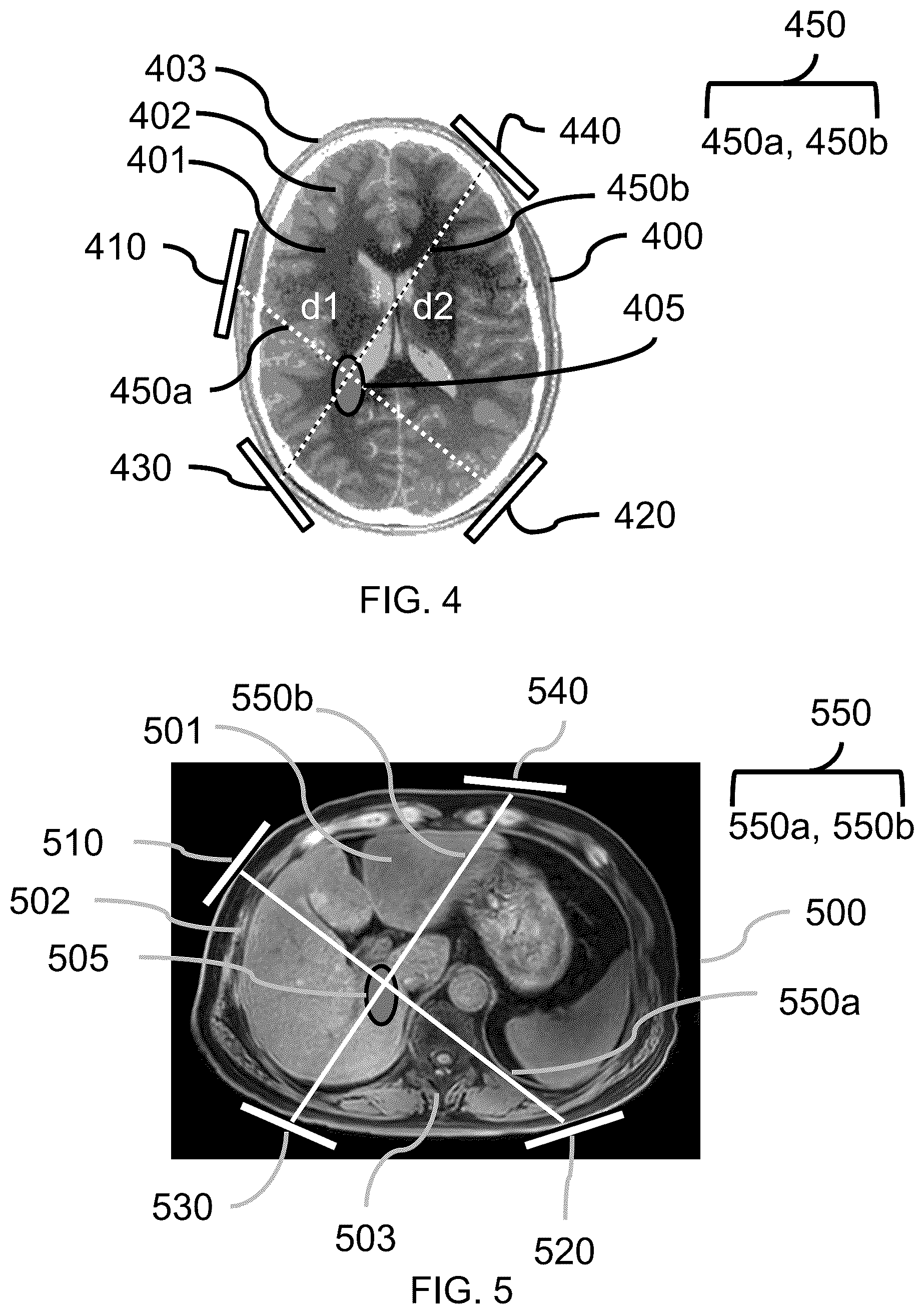 Patent US12333713 Figure 3 – Methods and apparatuses for determining transducer locations to generate tumor treating fields