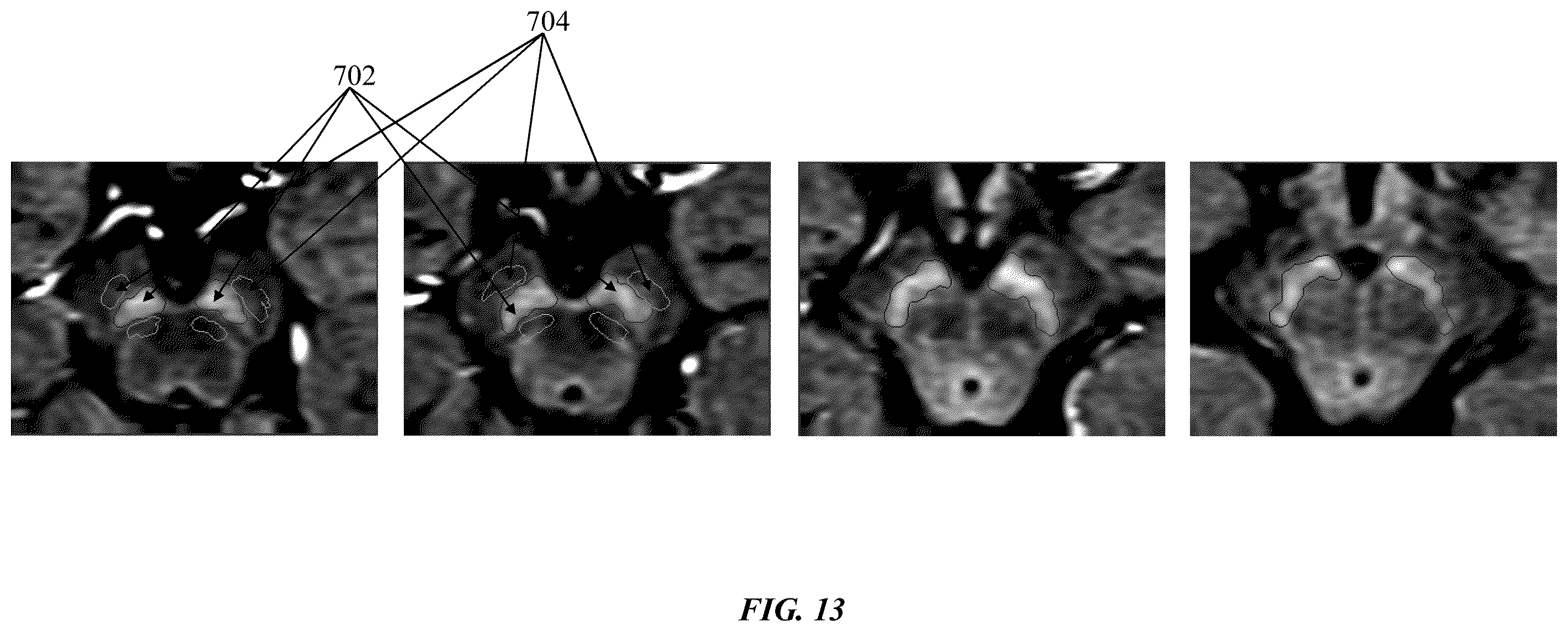 Patent US12333720 Figure 15 – Systems and methods for template-based automatic detection of anatomical structures