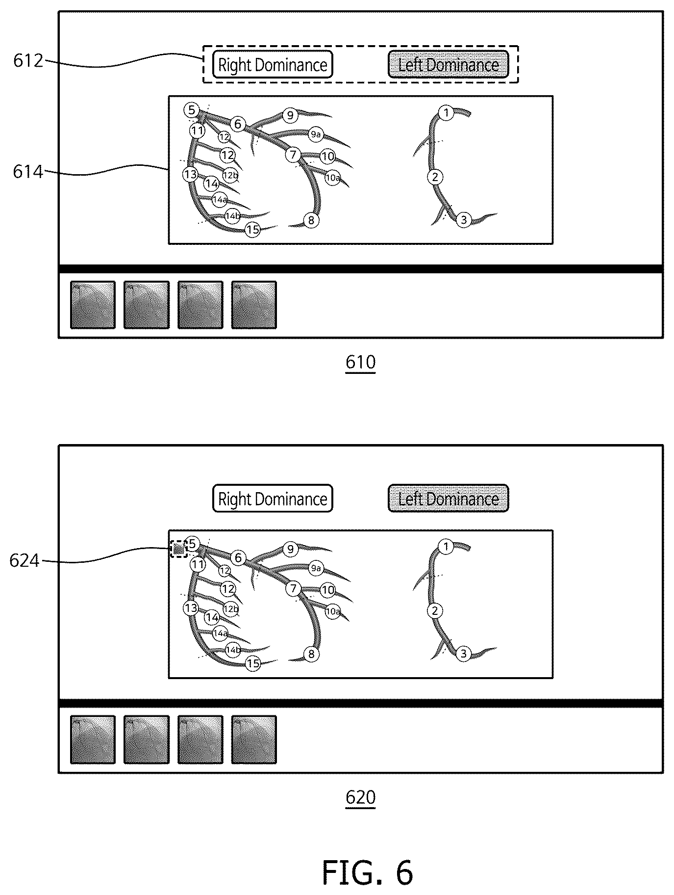 Patent US12333723 Figure 6 – Method and system for computing syntax score using cardio angiogram