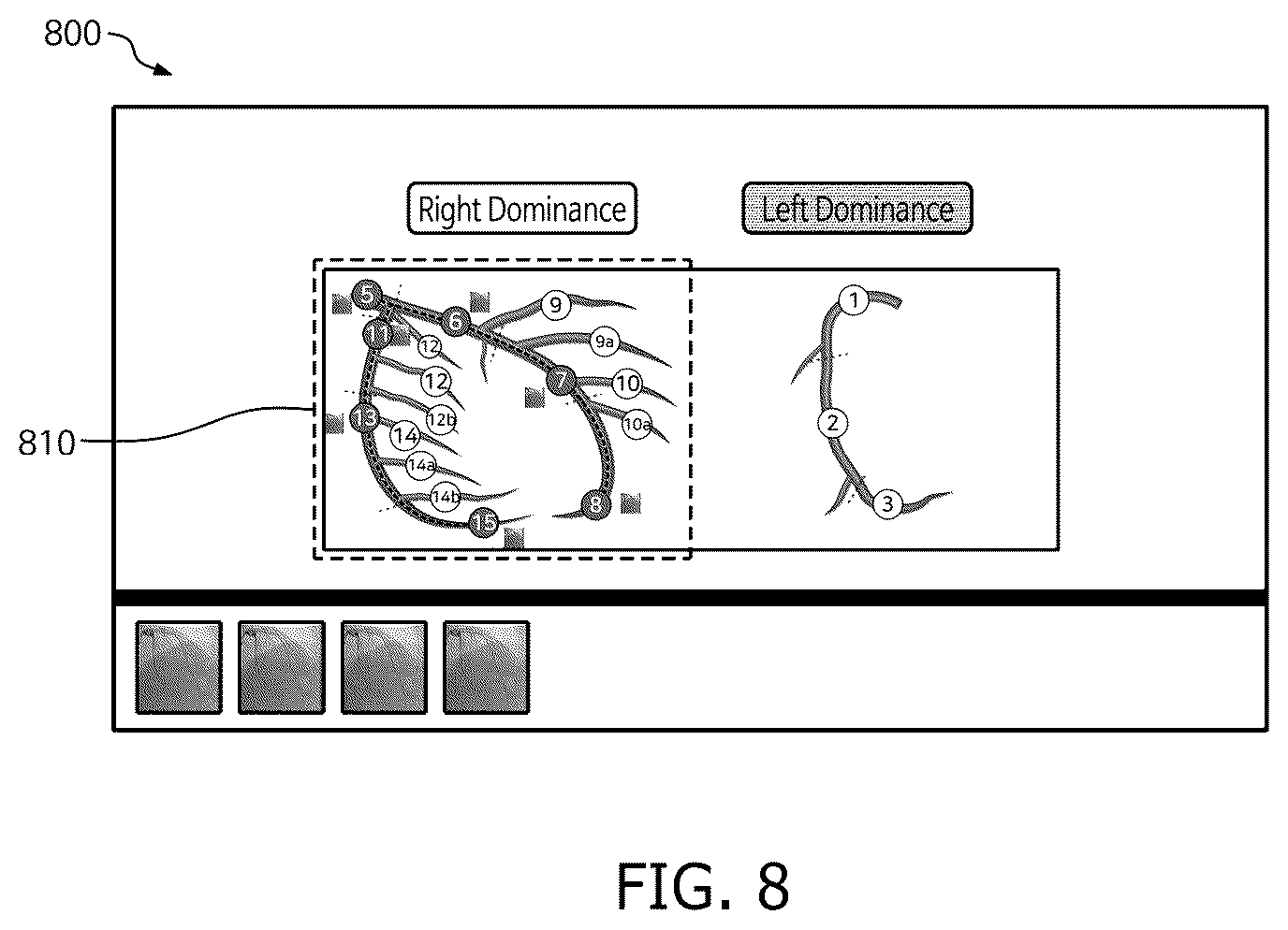 Patent US12333723 Figure 8 – Method and system for computing syntax score using cardio angiogram