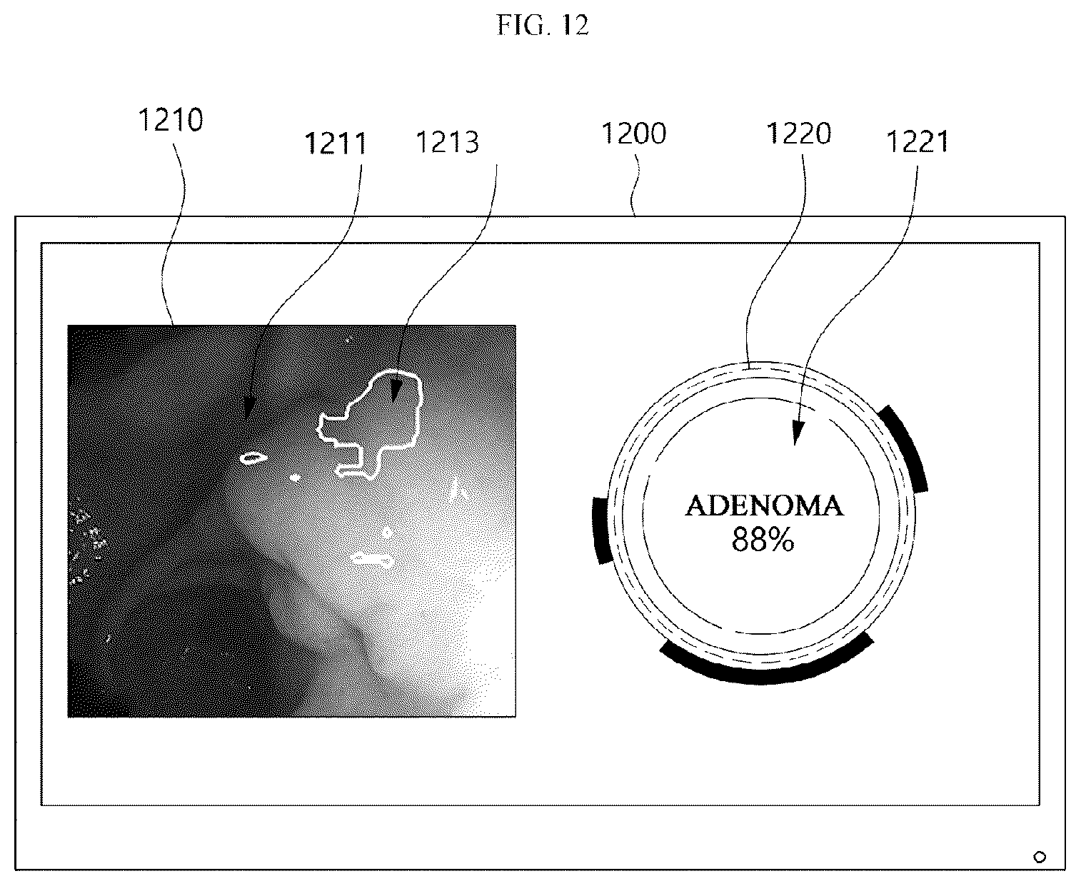Patent US12333724 Figure 12 – Electronic device for analyzing endoscopic images and providing information about a plurality of lesions, and endoscopic examination system including the electronic device