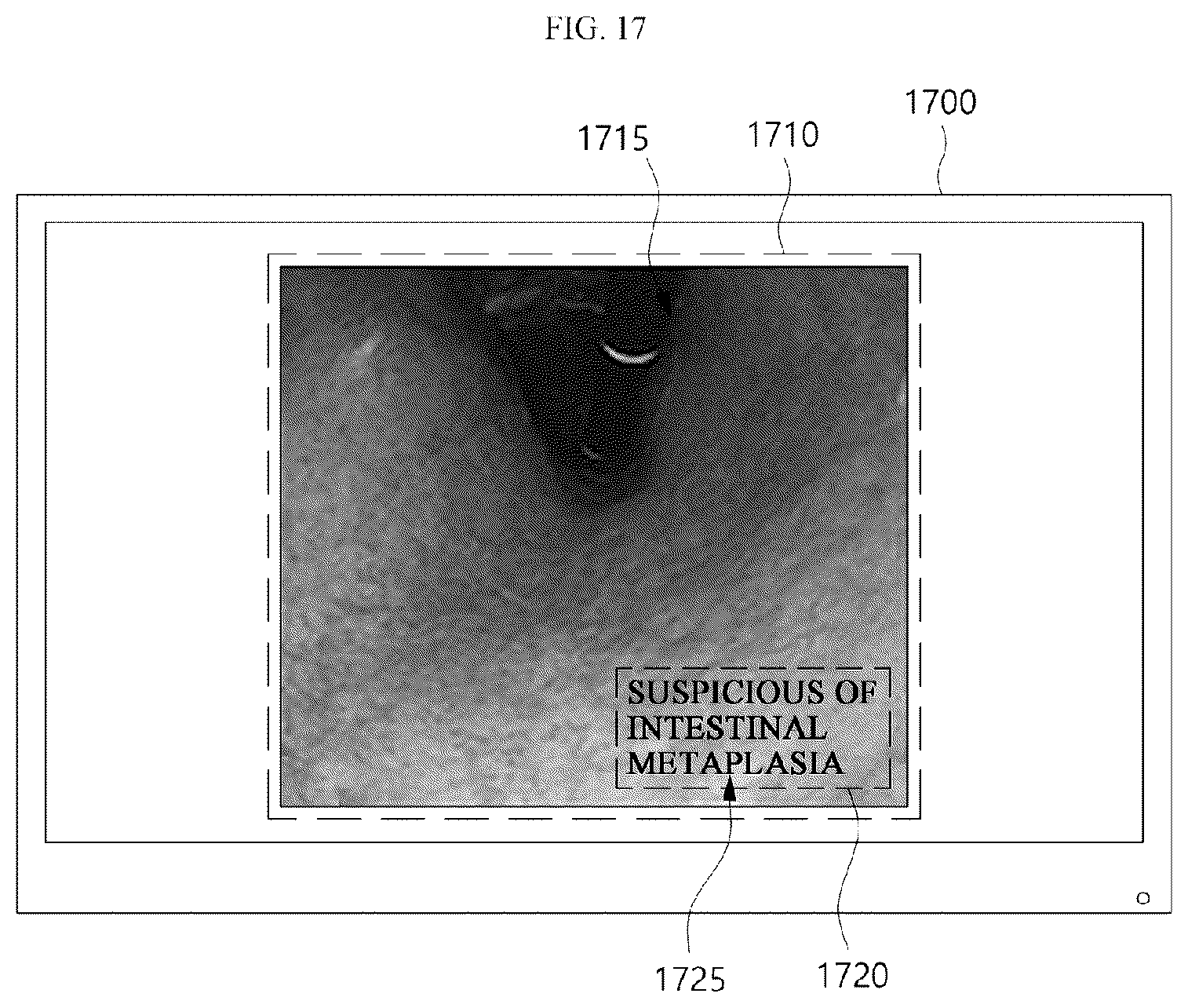 Patent US12333724 Figure 17 – Electronic device for analyzing endoscopic images and providing information about a plurality of lesions, and endoscopic examination system including the electronic device