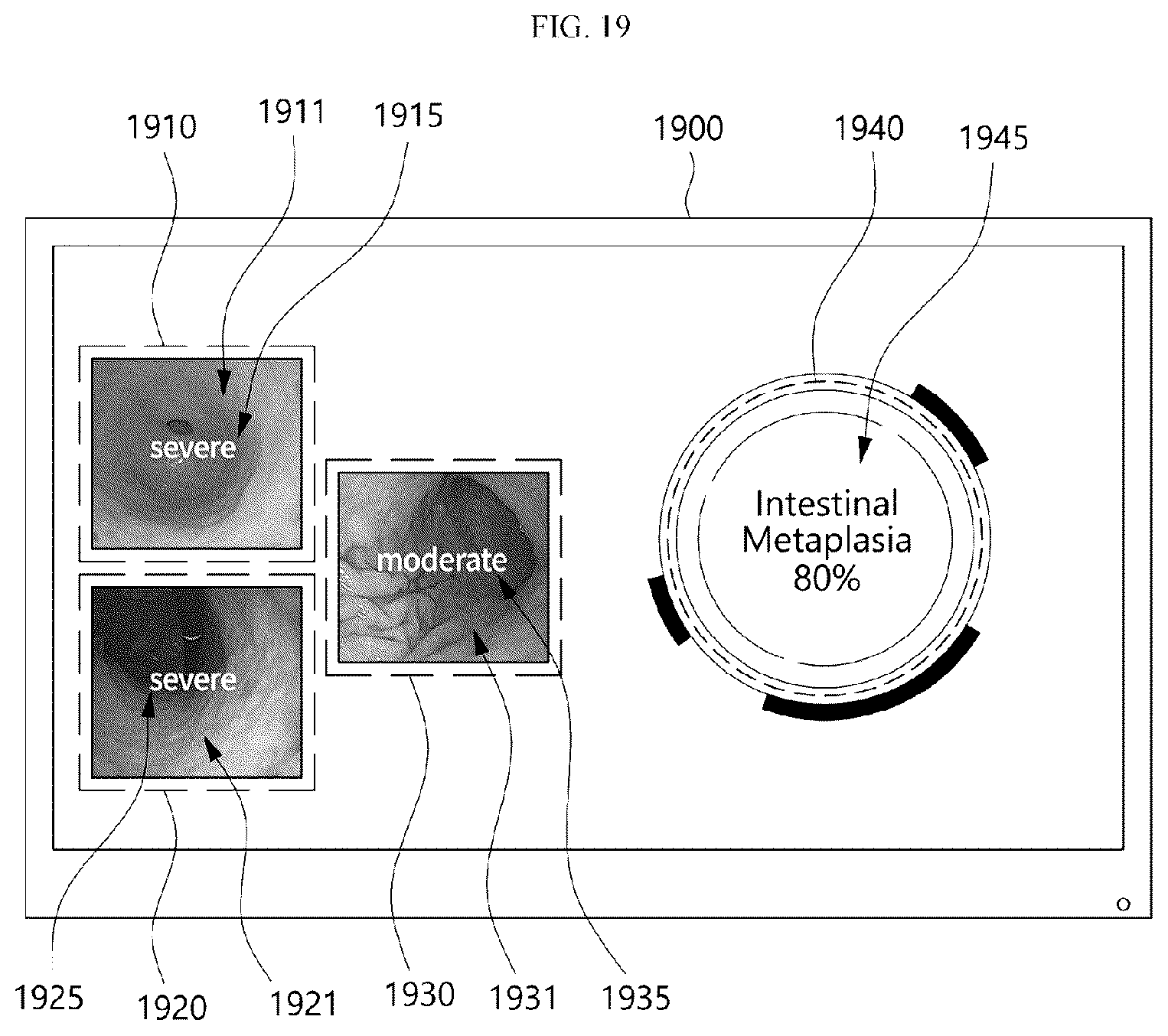 Patent US12333724 Figure 19 – Electronic device for analyzing endoscopic images and providing information about a plurality of lesions, and endoscopic examination system including the electronic device