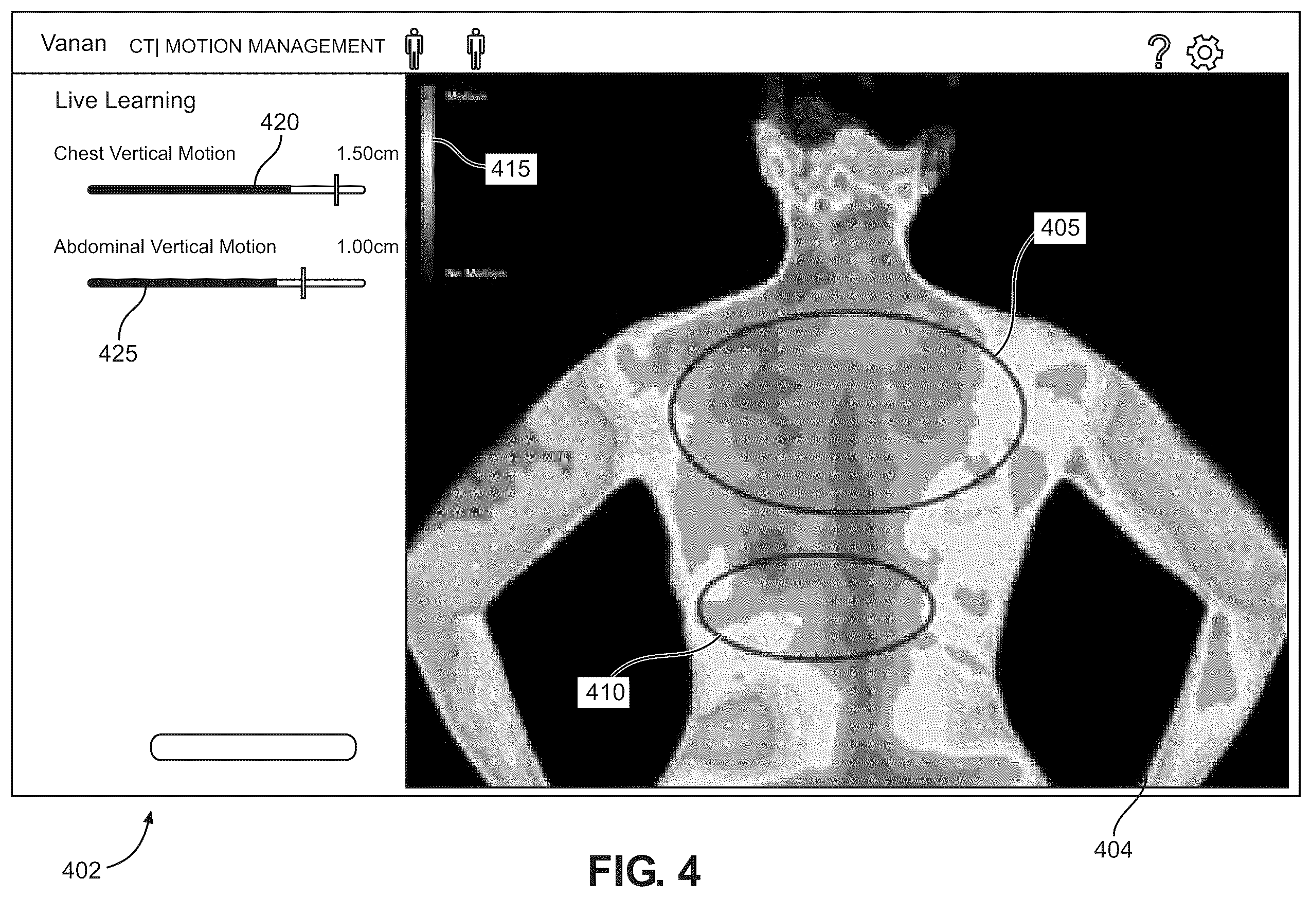 Patent US12333738 Figure 5 – Methods, systems and computer readable mediums for evaluating and displaying a breathing motion