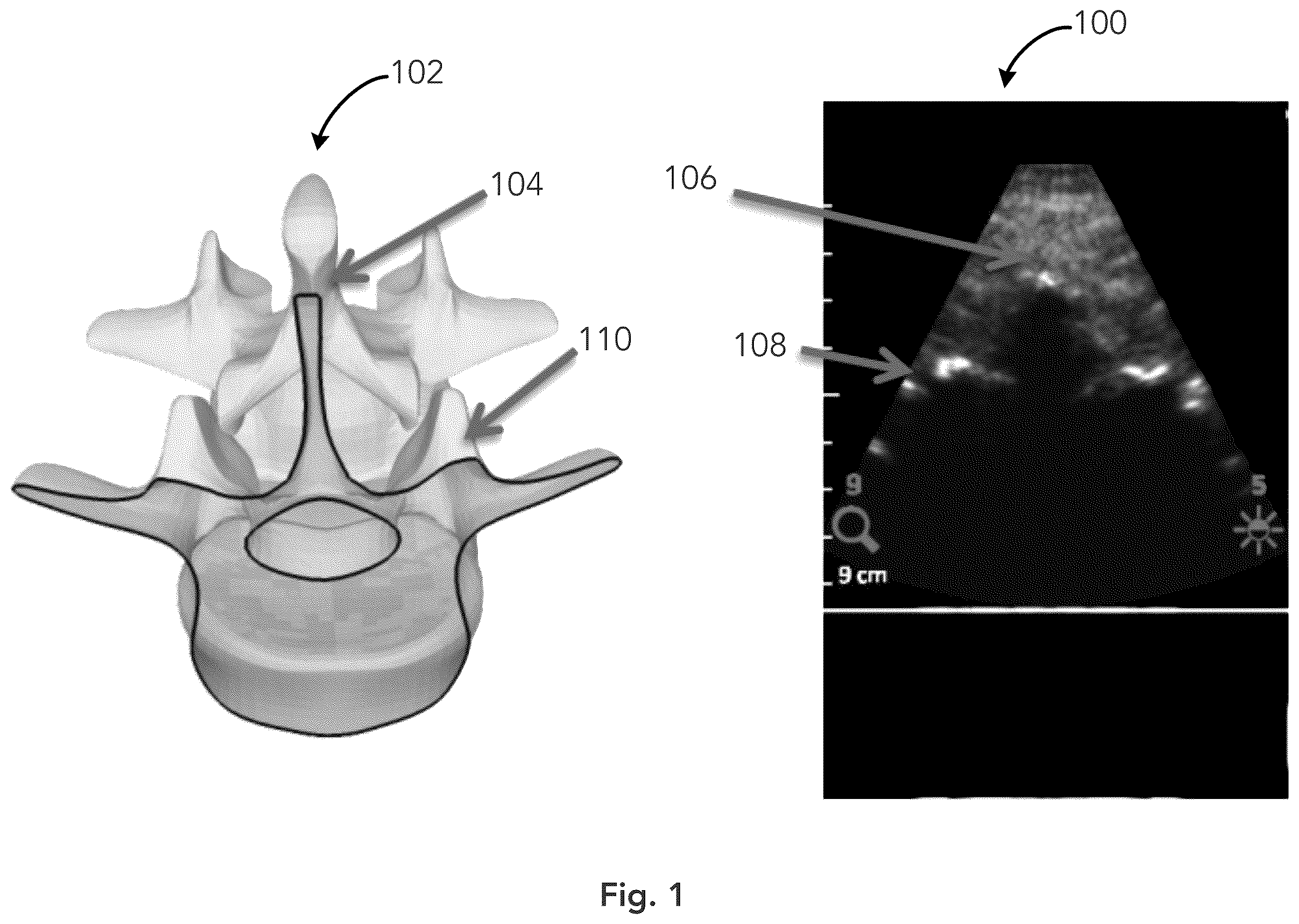 Patent US12333783 Figure 1 – System and method for ultrasound spine shadow feature detection and imaging thereof