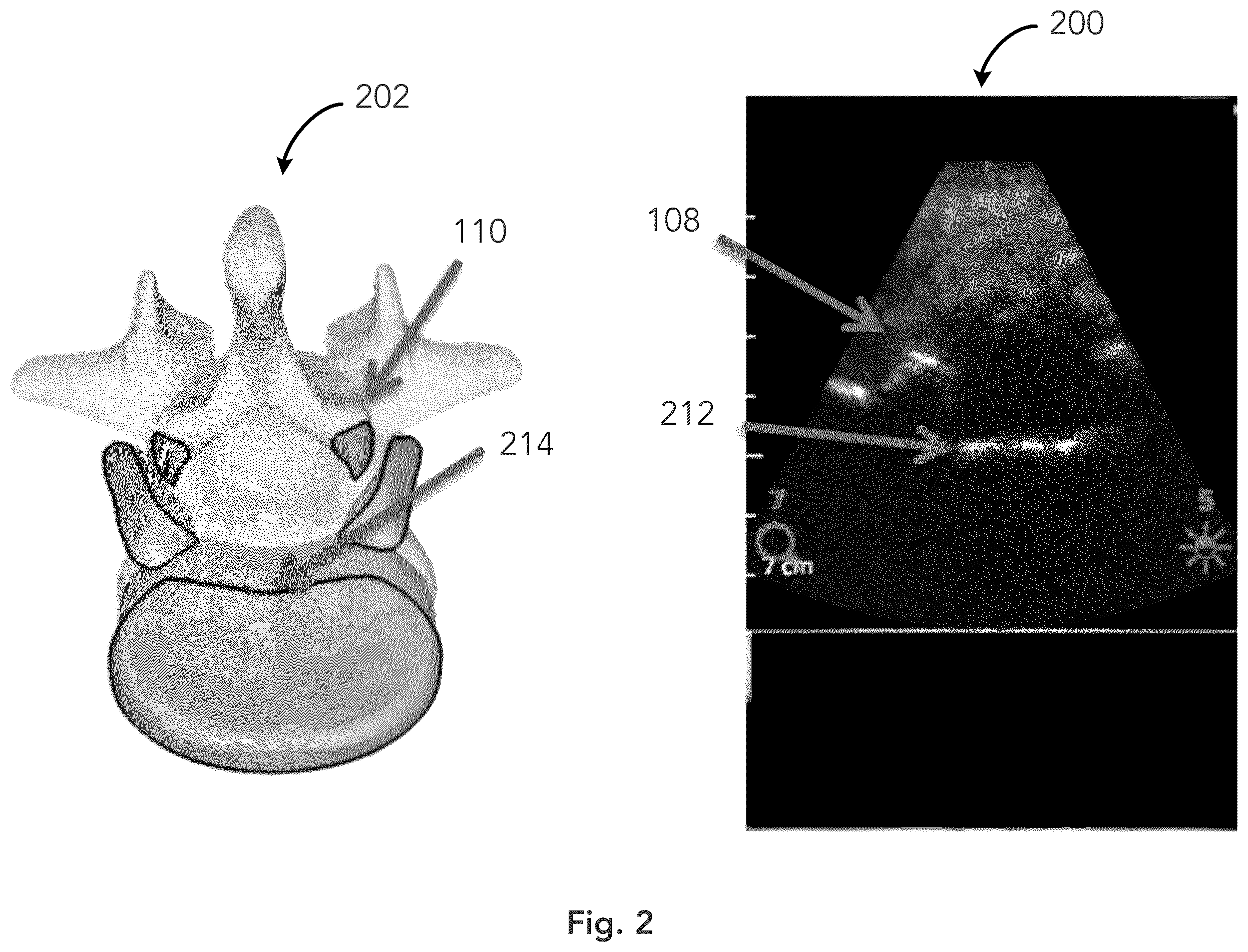 Patent US12333783 Figure 2 – System and method for ultrasound spine shadow feature detection and imaging thereof