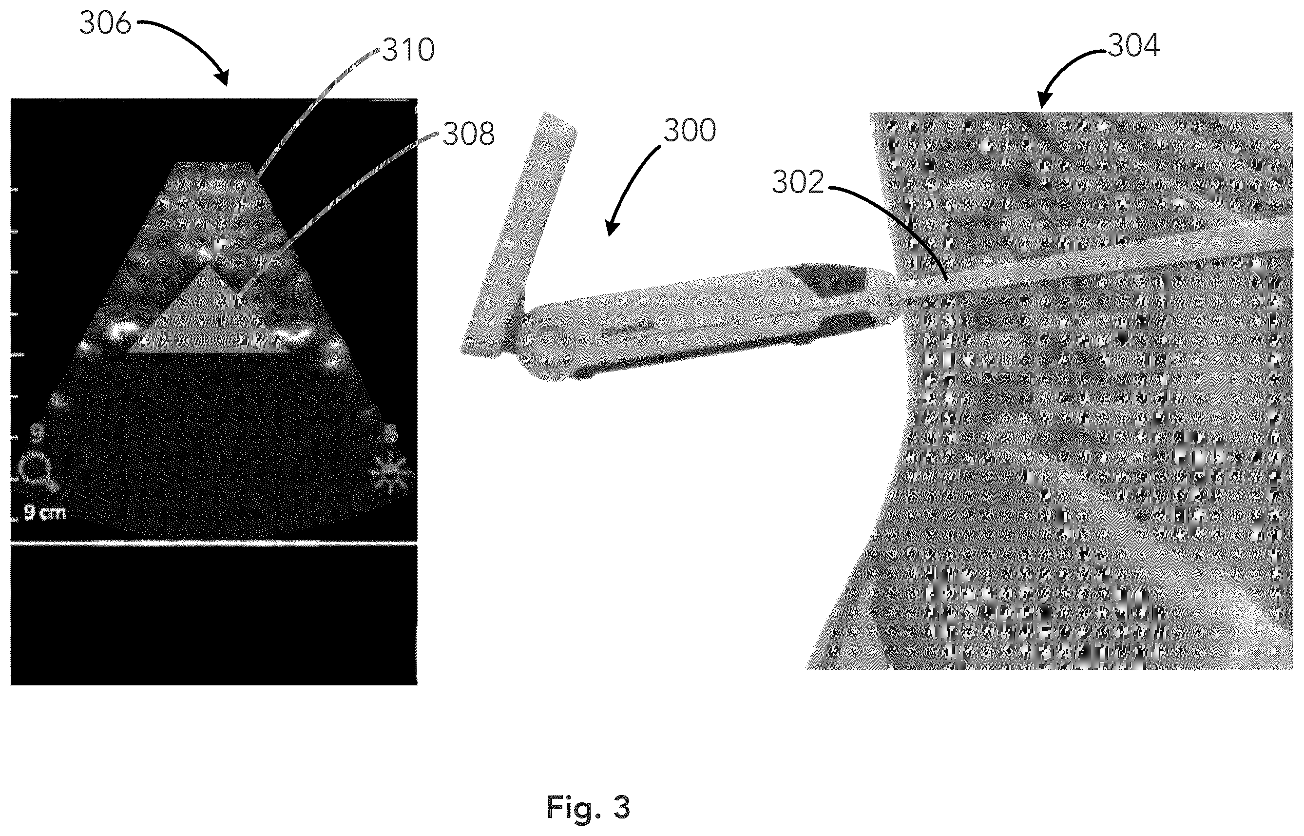 Patent US12333783 Figure 3 – System and method for ultrasound spine shadow feature detection and imaging thereof