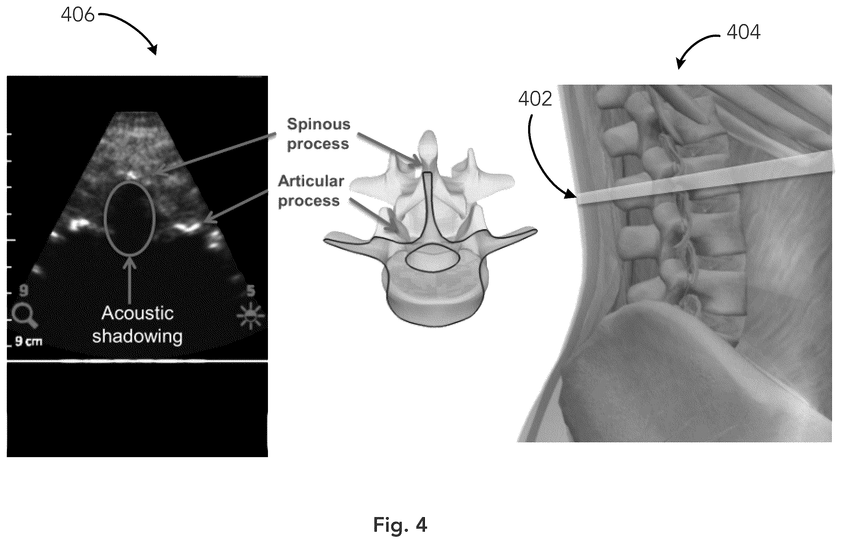 Patent US12333783 Figure 4 – System and method for ultrasound spine shadow feature detection and imaging thereof
