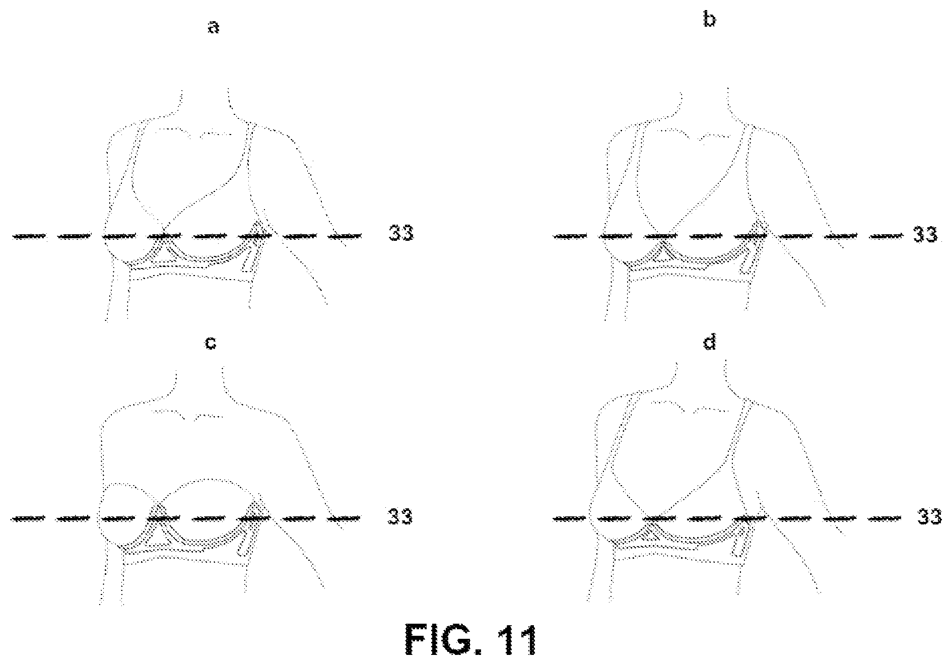 Patent US12342876 Figure 11 – Polymeric breast support structure