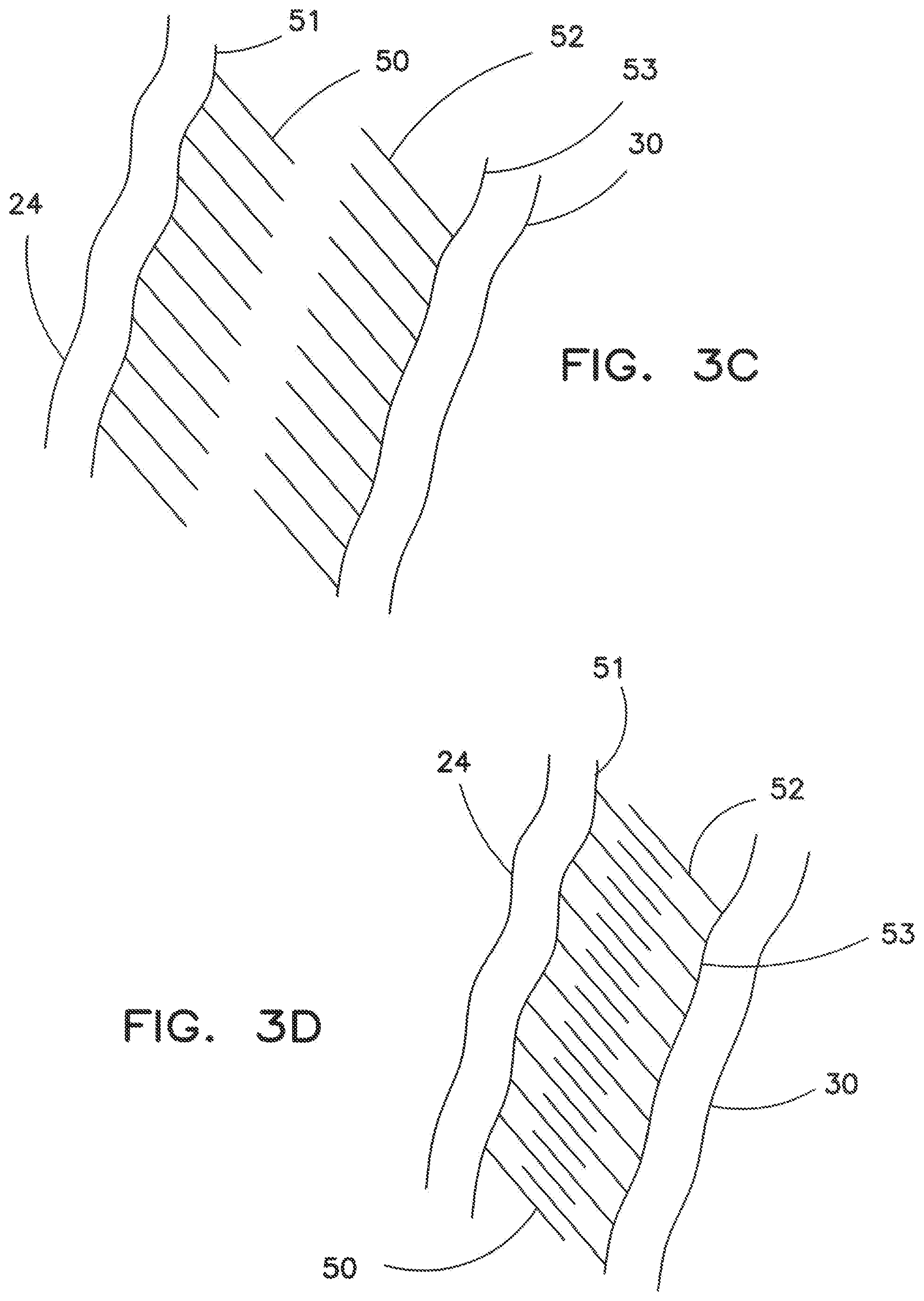 Patent US12342888 Figure 5 – Garment with compression adjustment arrangement