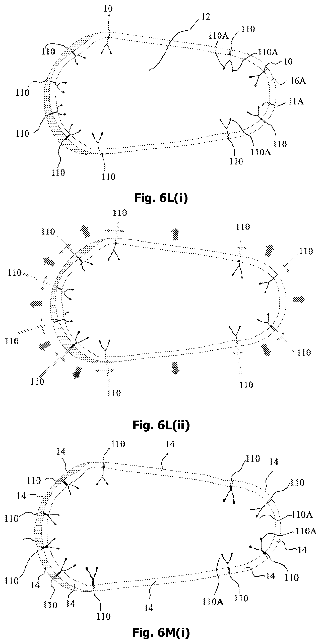 Patent US12342905 Figure 12 – Expandable shoe capable to grow with a wearer/user's feet for more than three sizes