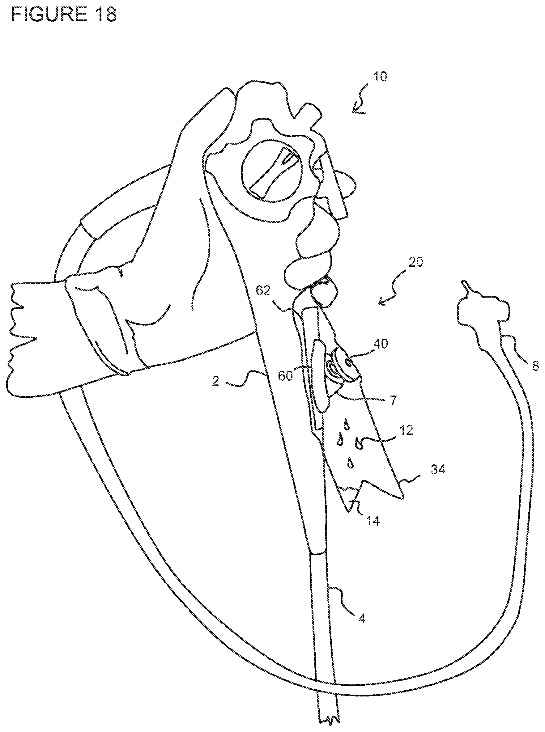 Patent US12342986 Figure 9 – Device for collection of excess fluids from an endoscope