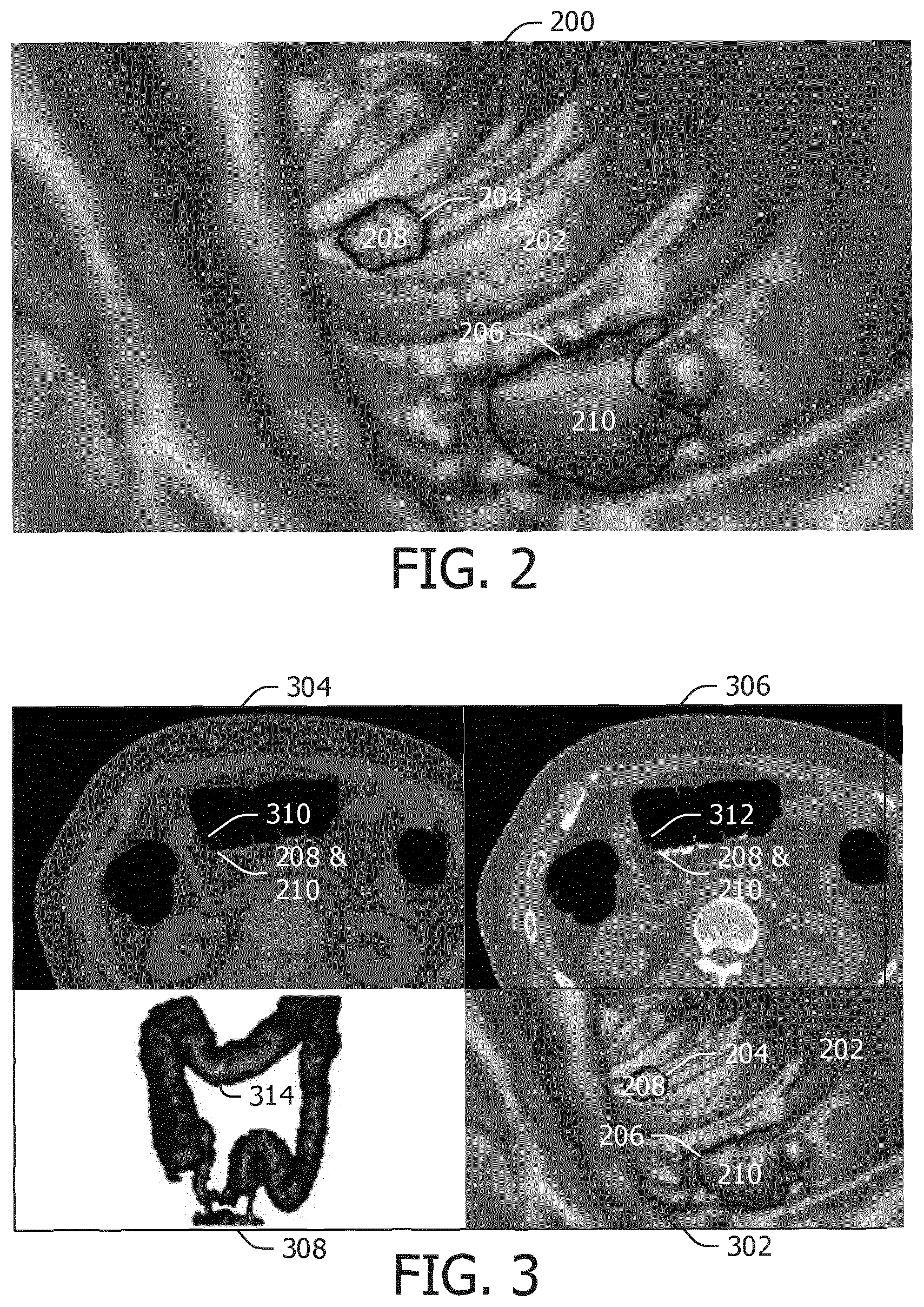 Patent US12347053 Figure 2 – 3-D virtual endoscopy rendering