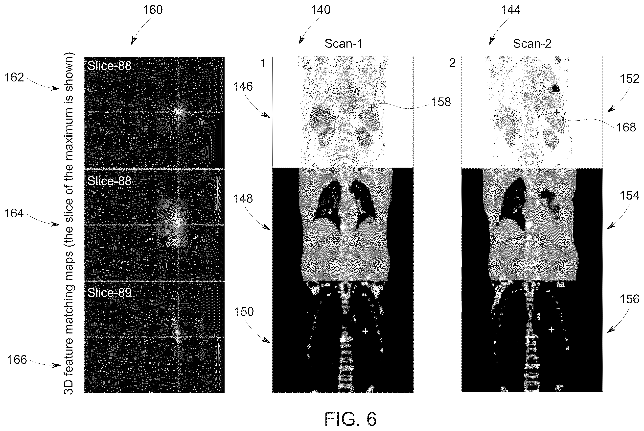 Patent US12347108 Figure 5 – System and method for follow-up local feature matching based on multiple functional-anatomical feature layers