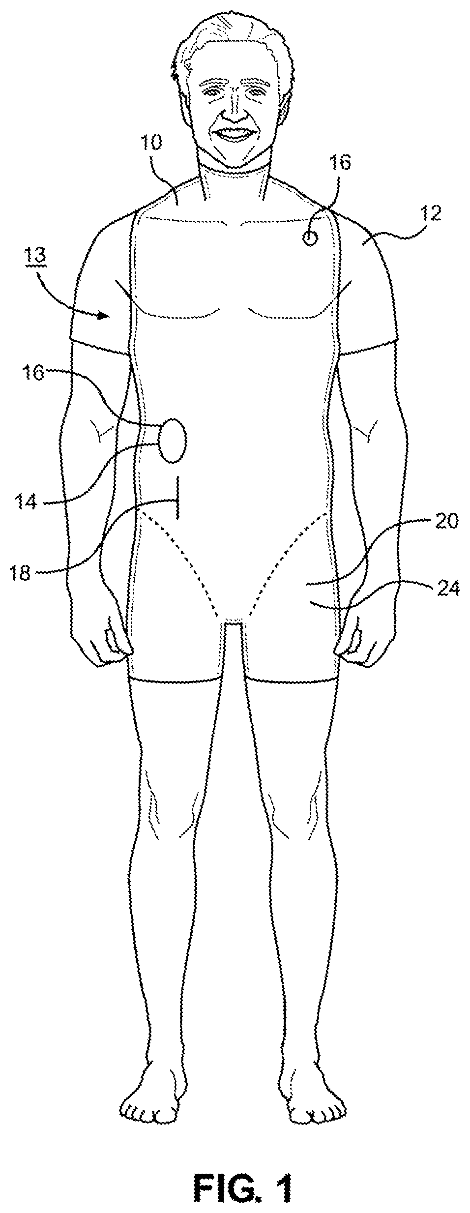 Patent US12347338 Figure 1 – Prosthetic internal organ module