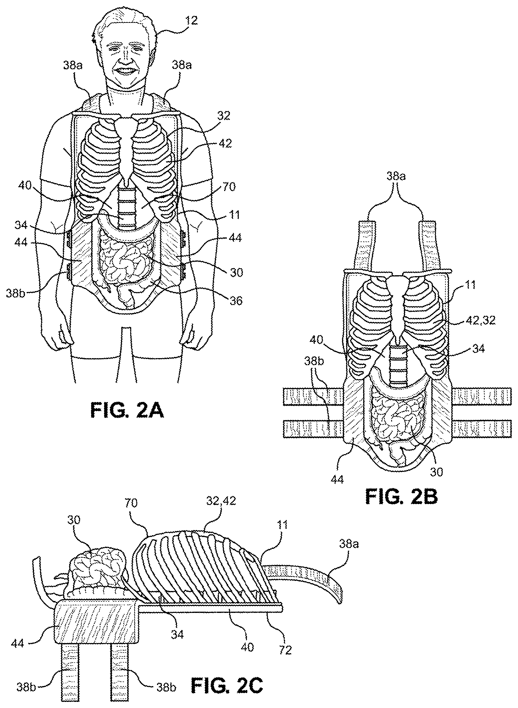 Patent US12347338 Figure 2 – Prosthetic internal organ module