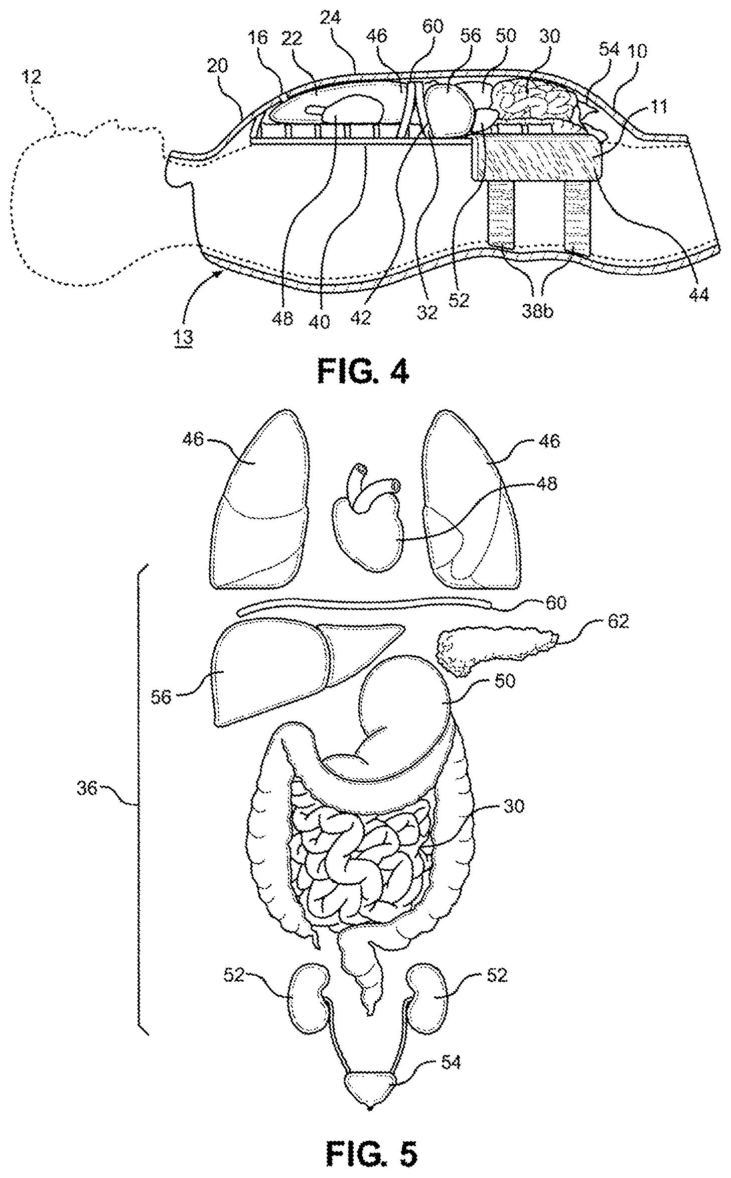 Patent US12347338 Figure 4 – Prosthetic internal organ module
