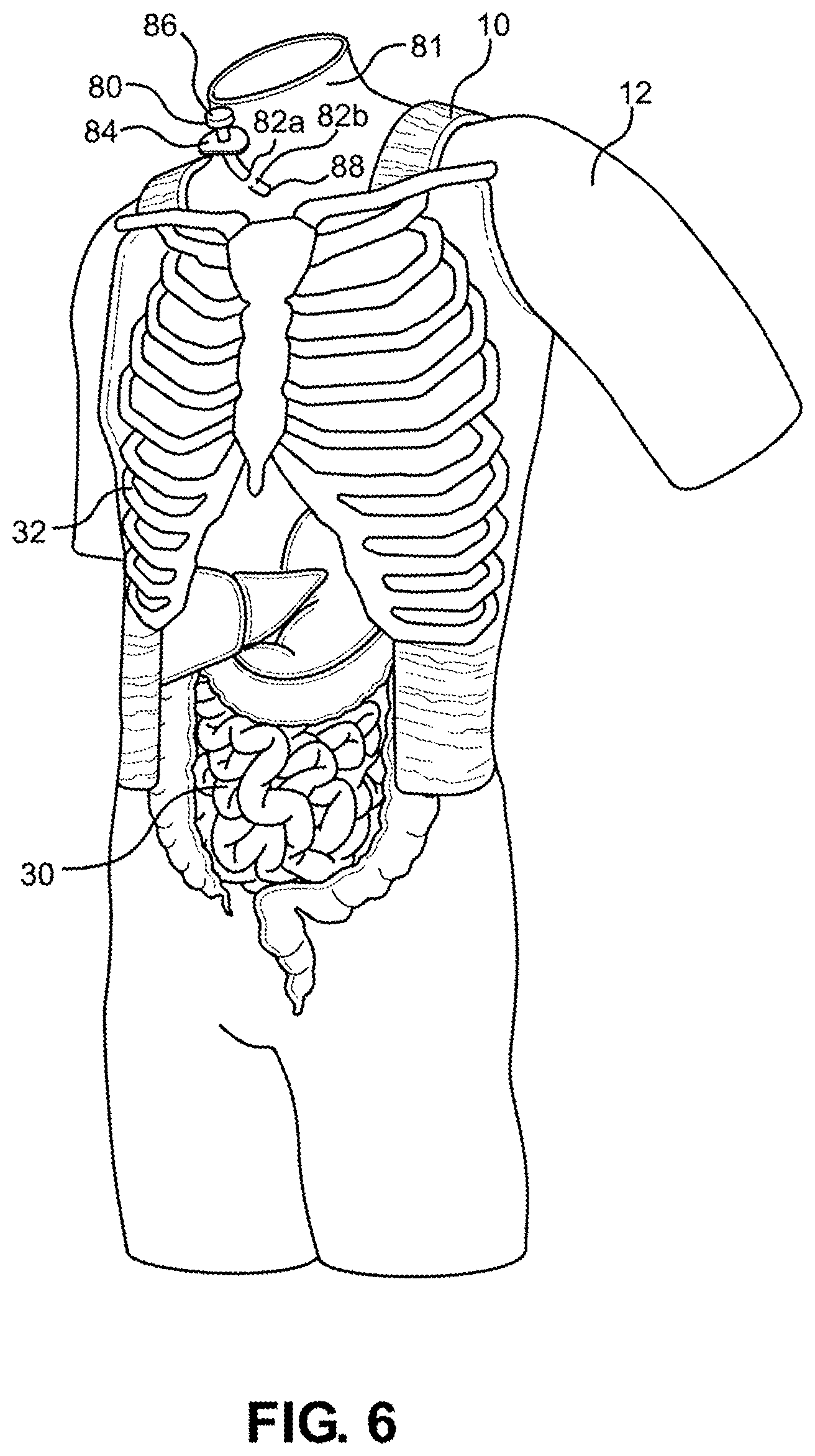 Patent US12347338 Figure 5 – Prosthetic internal organ module