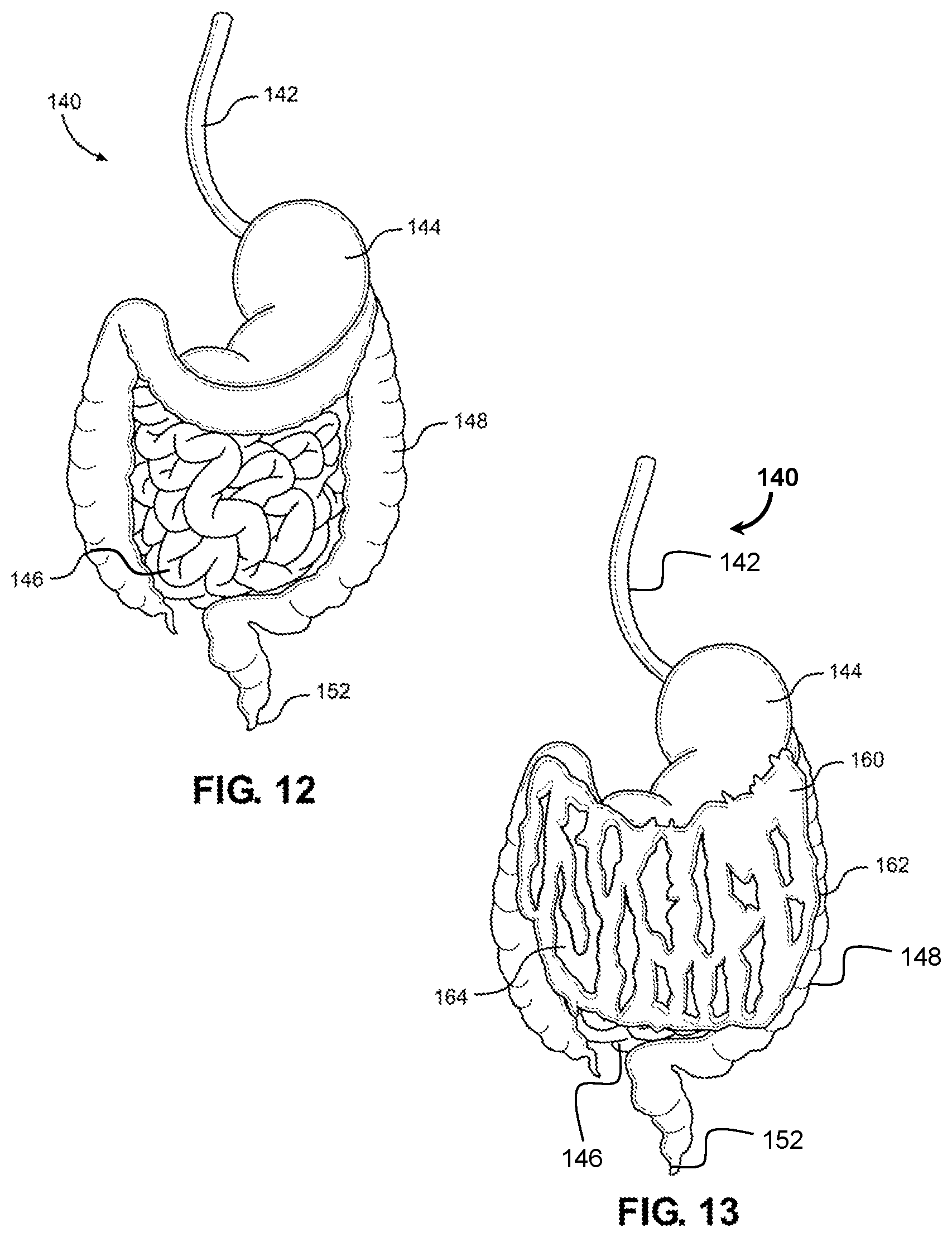 Patent US12347338 Figure 9 – Prosthetic internal organ module