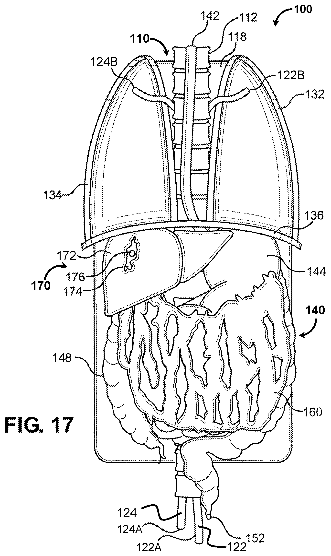Patent US12347338 Figure 12 – Prosthetic internal organ module