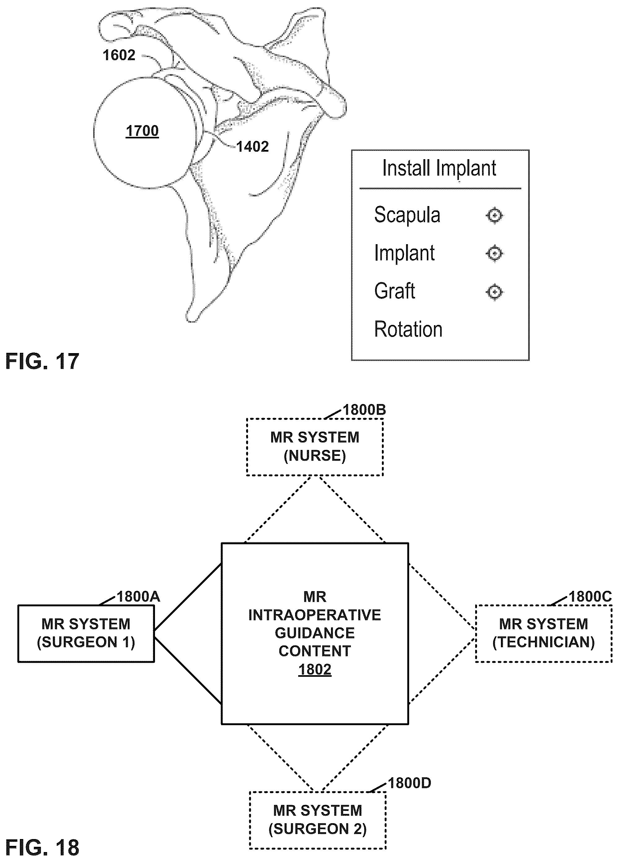 Patent US12347545 Figure 15 – Automated instrument or component assistance using externally controlled light sources in orthopedic surgical procedures