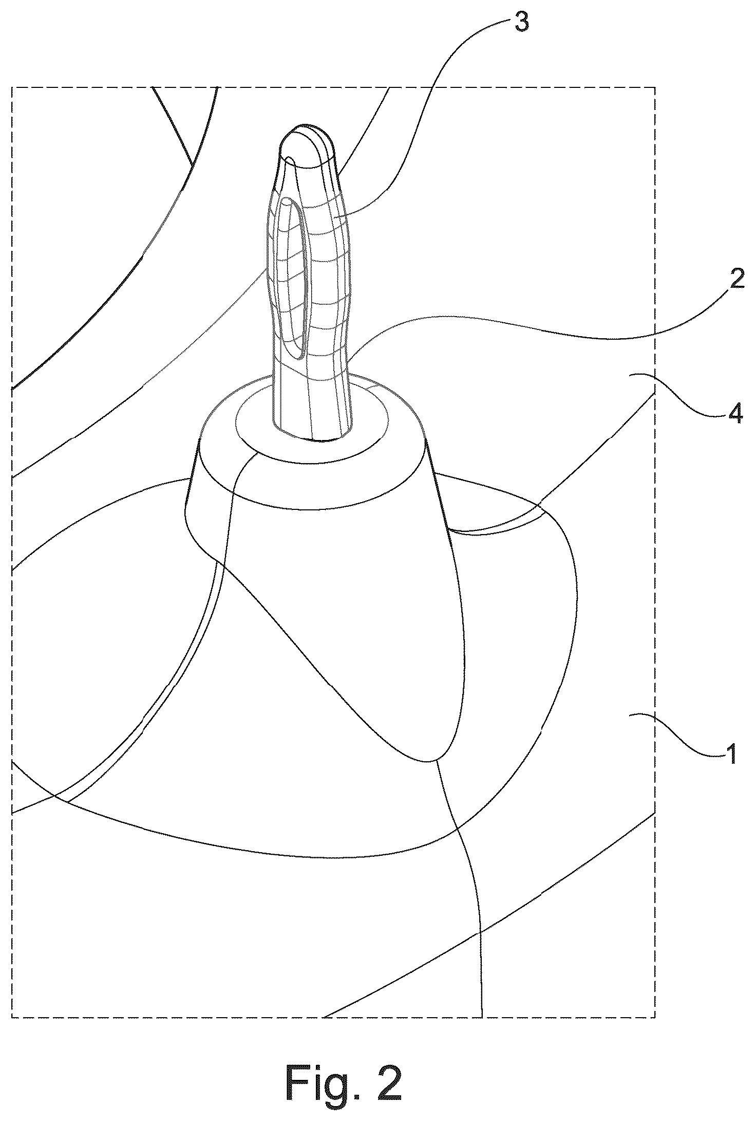 Patent US12348097 Figure 2 – Method for electrically contacting at least one enameled copper wire with a component of an electric motor, generator, sensor or electromagnet by means of electrical contacts formed on the enameled copper wires and additional potting