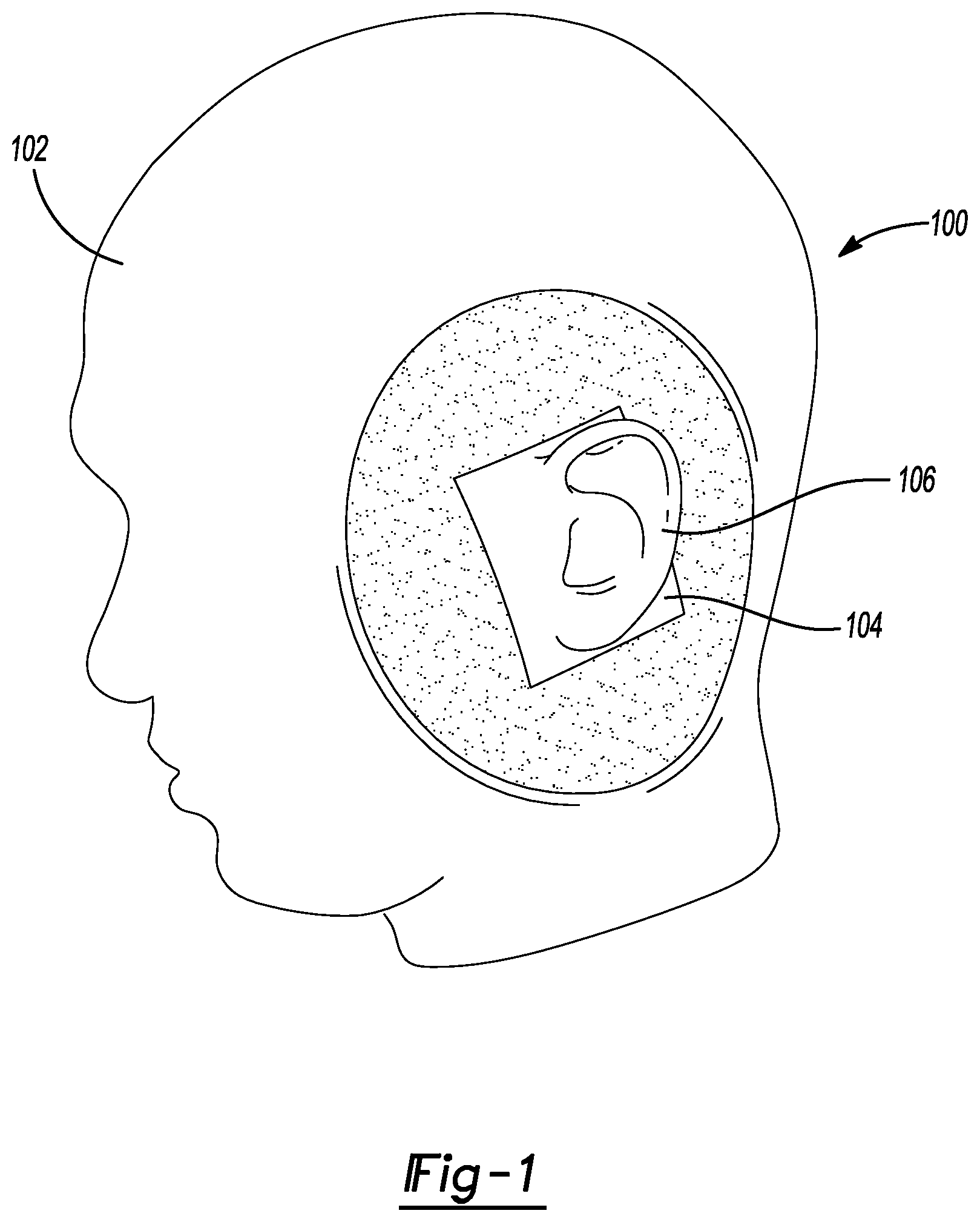 Patent US12348919 Figure 1 – Insert for headphone measurements on a head shaped fixture