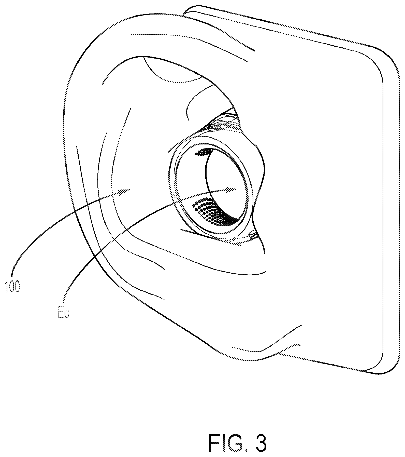 Patent US12348925 Figure 3 – Ringed-shaped biometric earpiece