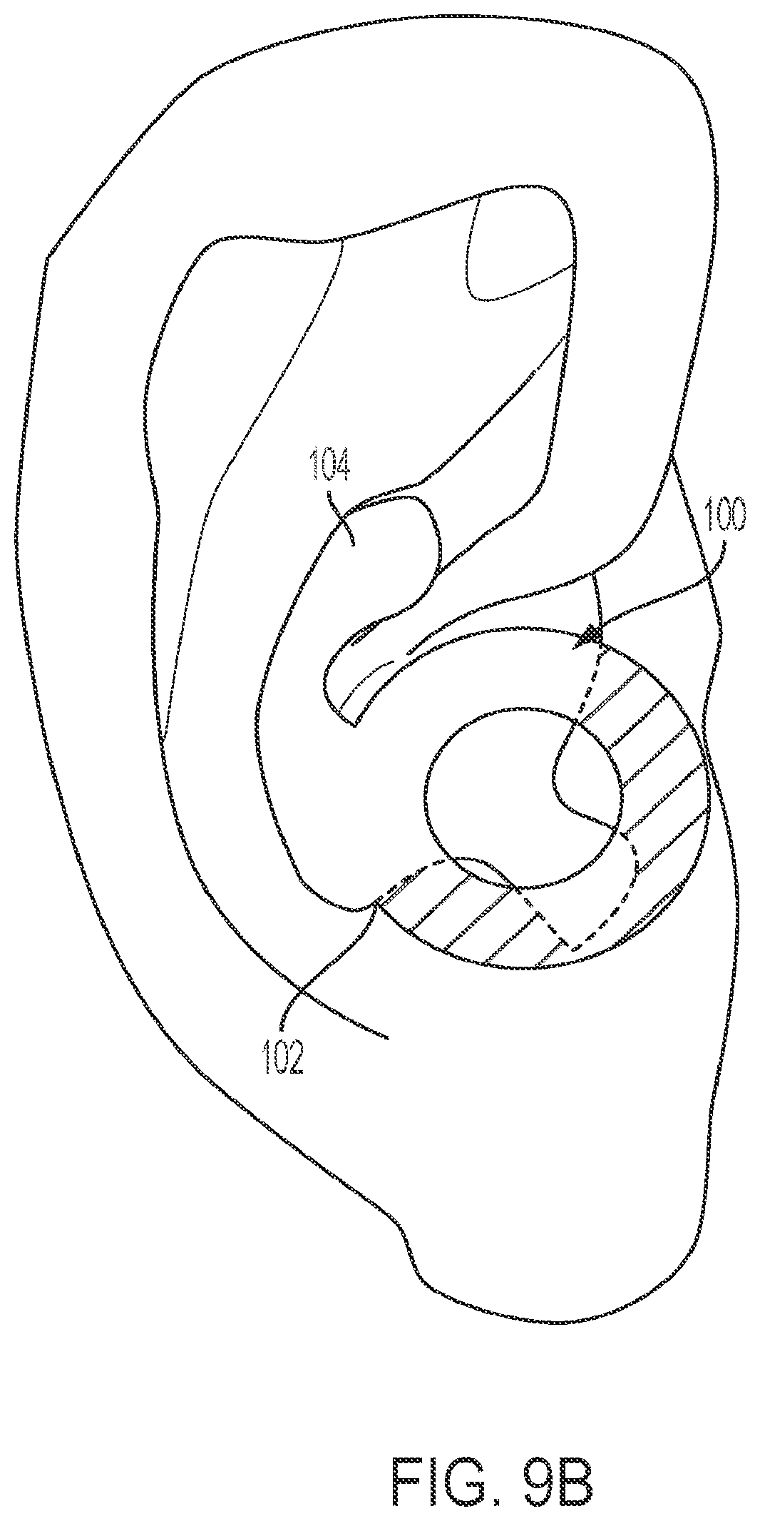 Patent US12348925 Figure 14 – Ringed-shaped biometric earpiece