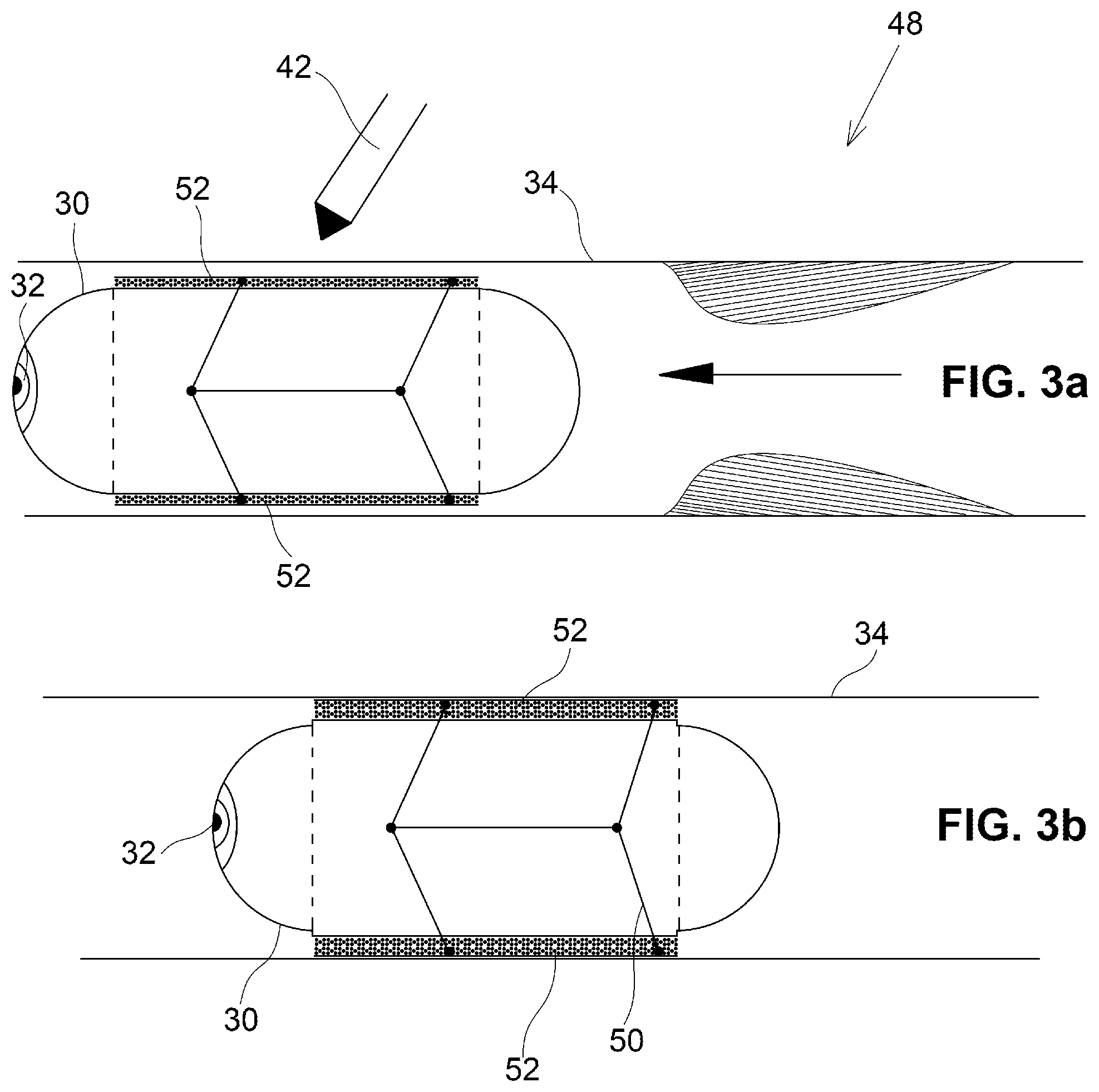 Patent US12350001 Figure 3 – System and method for catheterization using an intraluminal electromagnetic working capsule