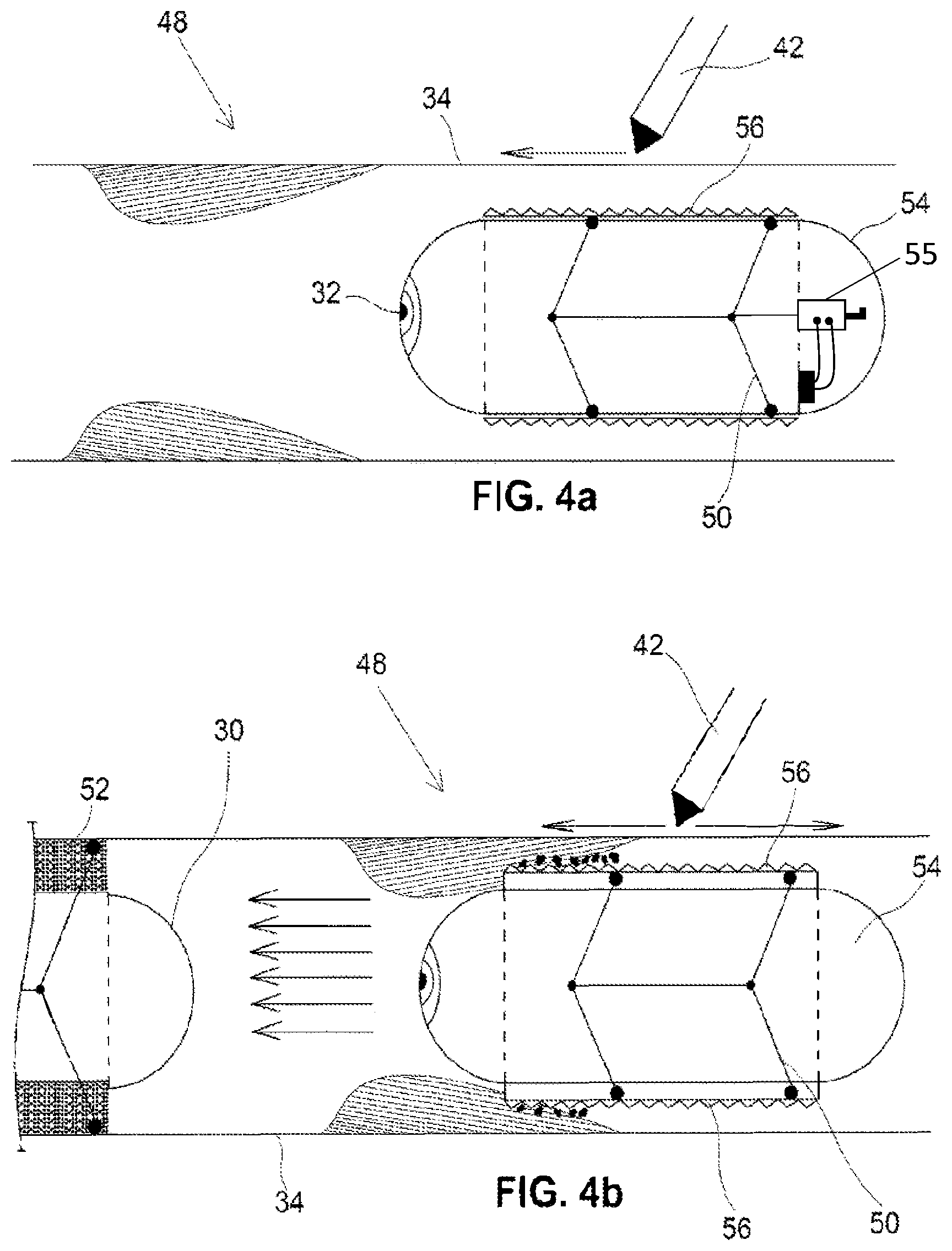 Patent US12350001 Figure 4 – System and method for catheterization using an intraluminal electromagnetic working capsule