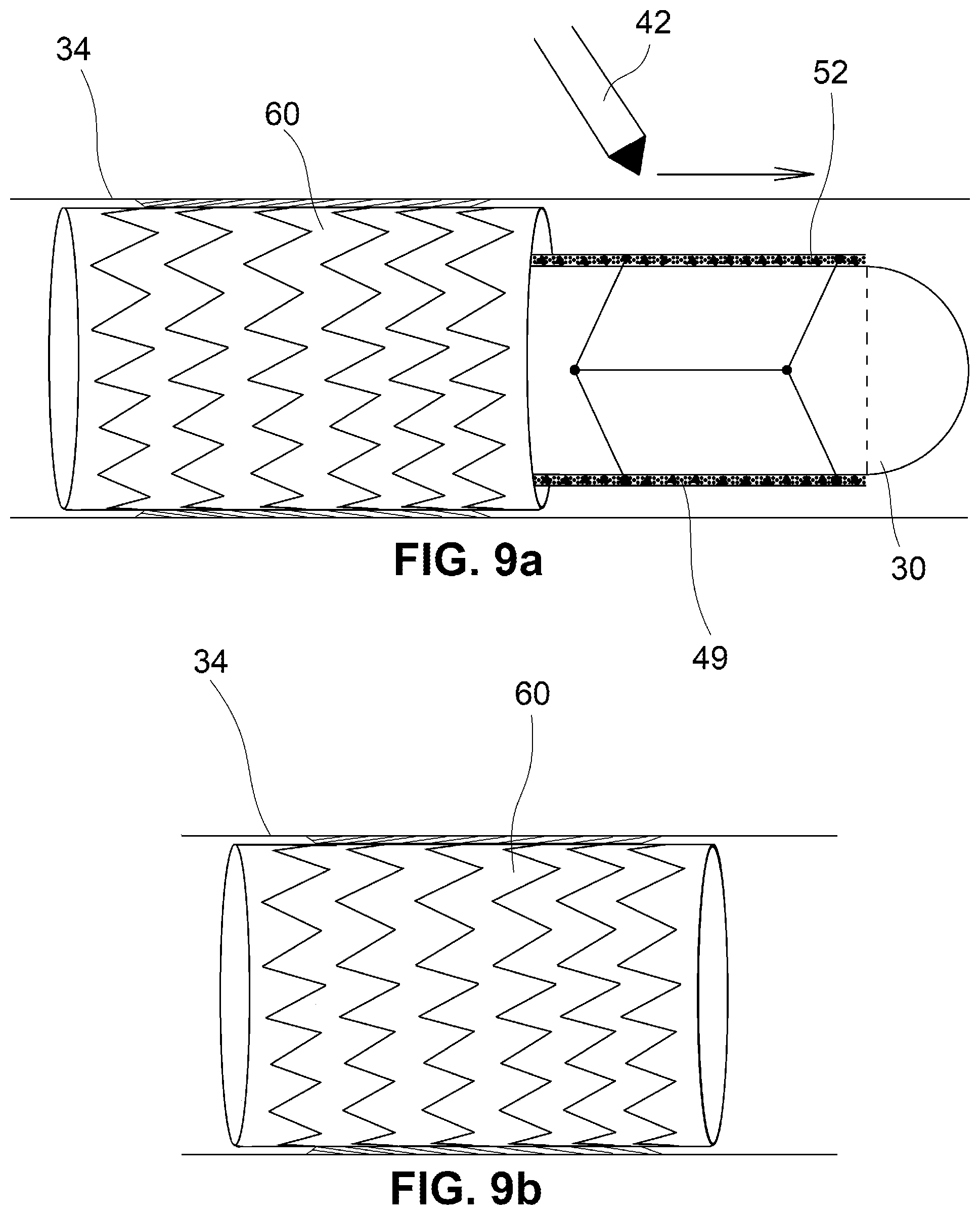 Patent US12350001 Figure 10 – System and method for catheterization using an intraluminal electromagnetic working capsule