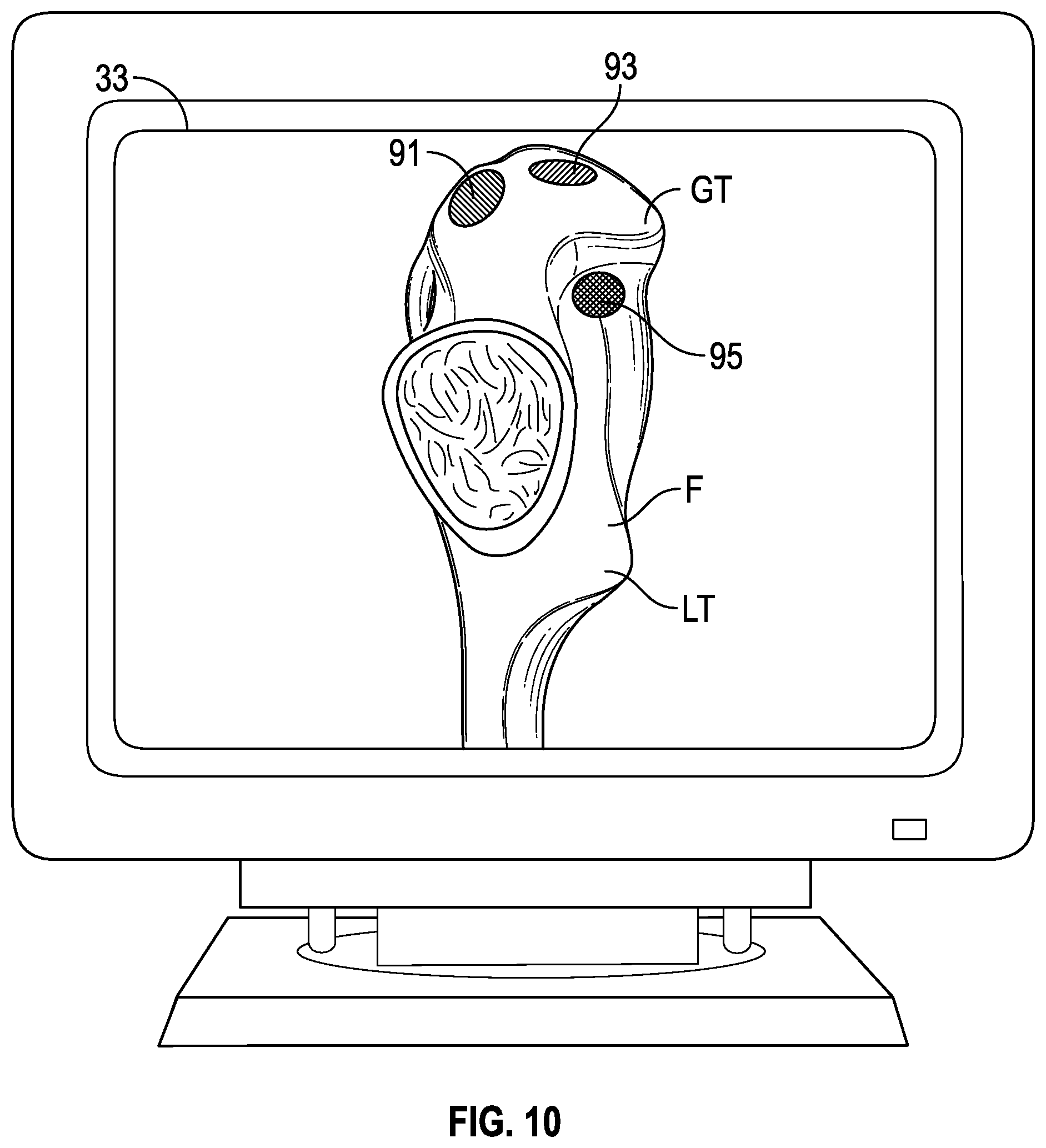 Patent US12350002 Figure 9 – Soft tissue cutting instrument and method of use