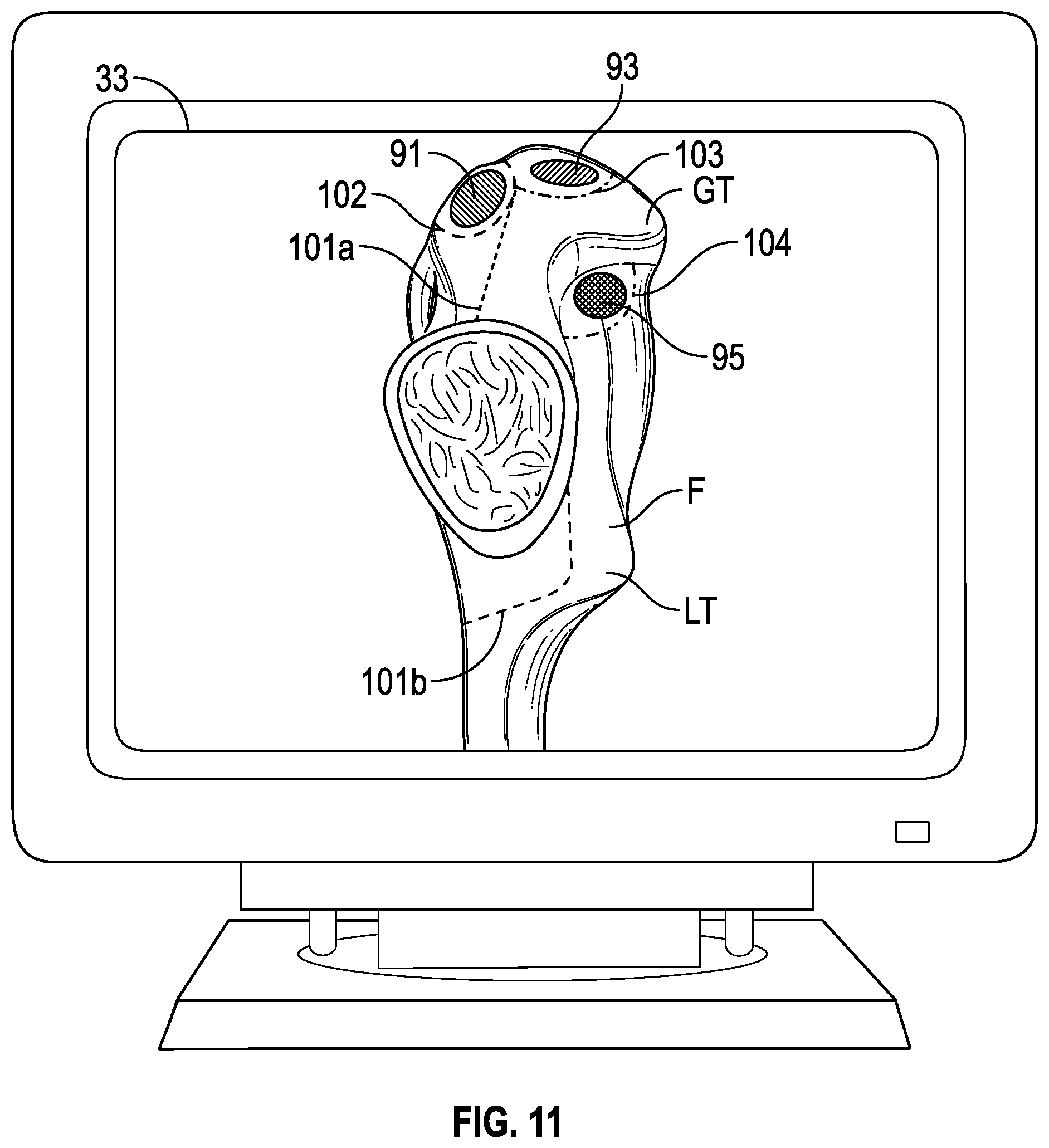 Patent US12350002 Figure 10 – Soft tissue cutting instrument and method of use