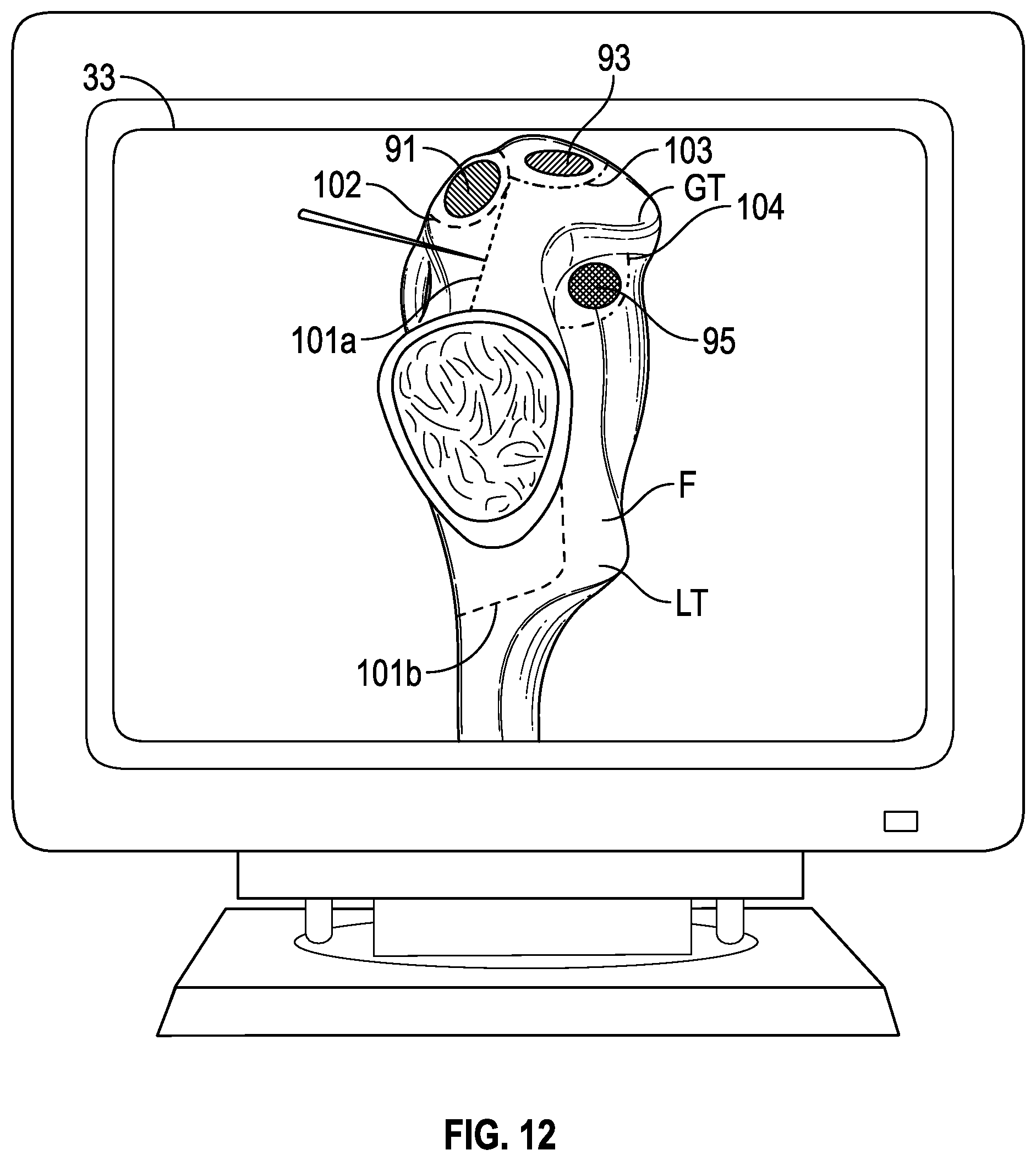 Patent US12350002 Figure 11 – Soft tissue cutting instrument and method of use