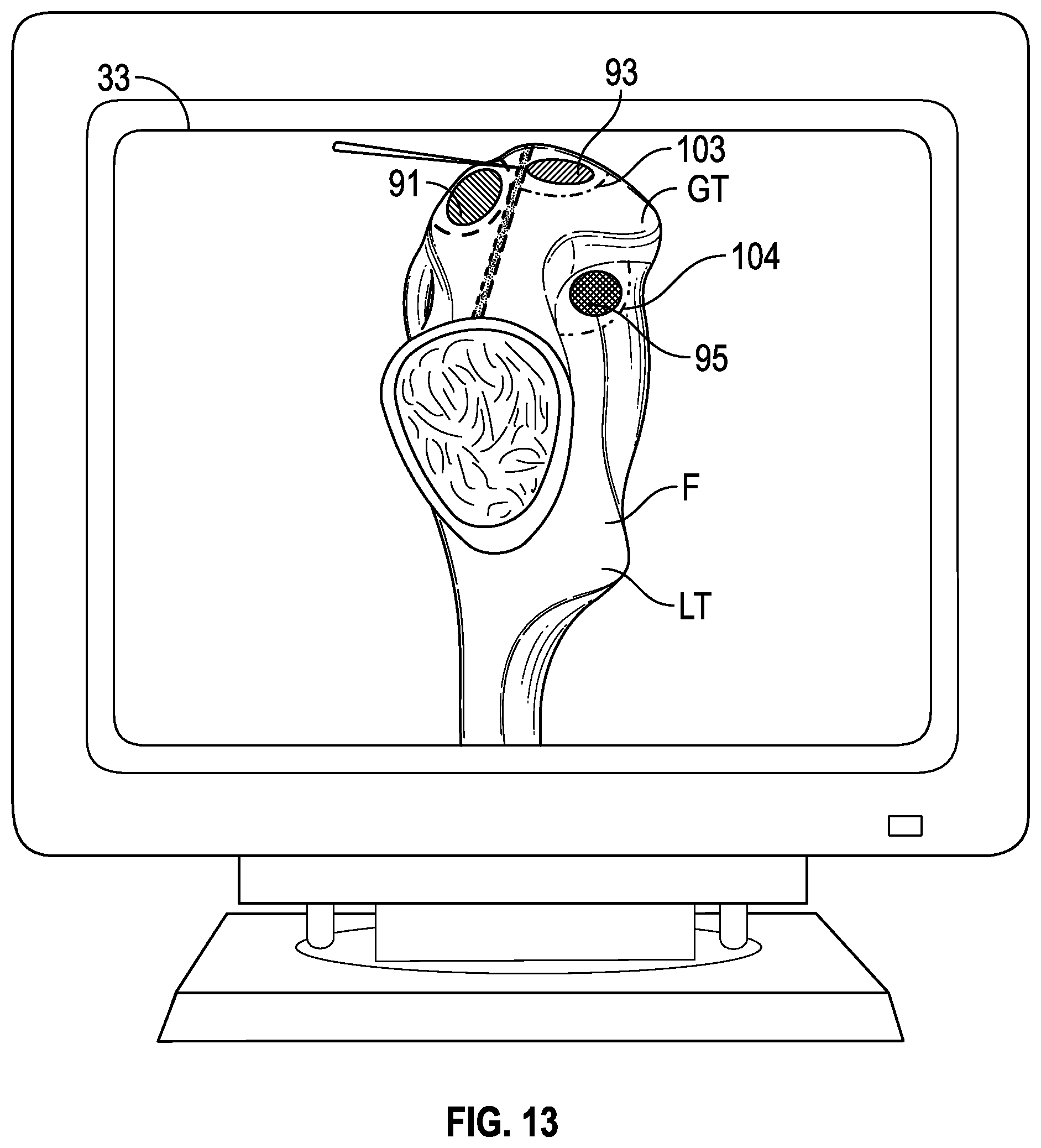 Patent US12350002 Figure 12 – Soft tissue cutting instrument and method of use