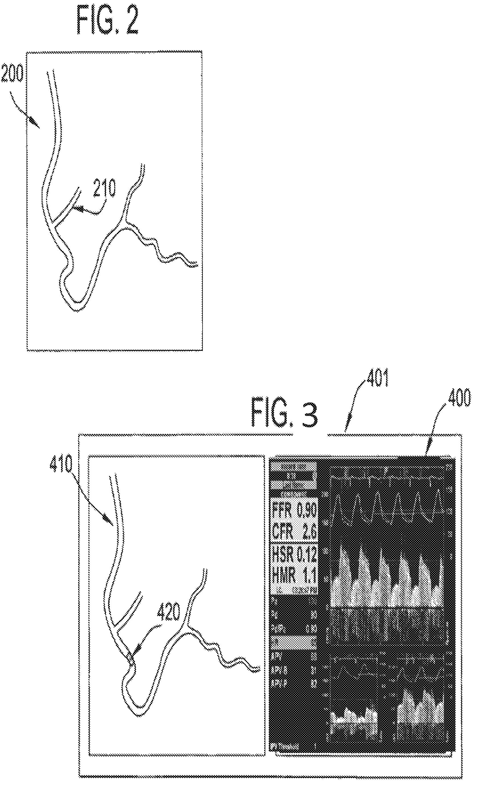 Patent US12350018 Figure 2 – Systems and methods for diagnosing coronary microvascular disease