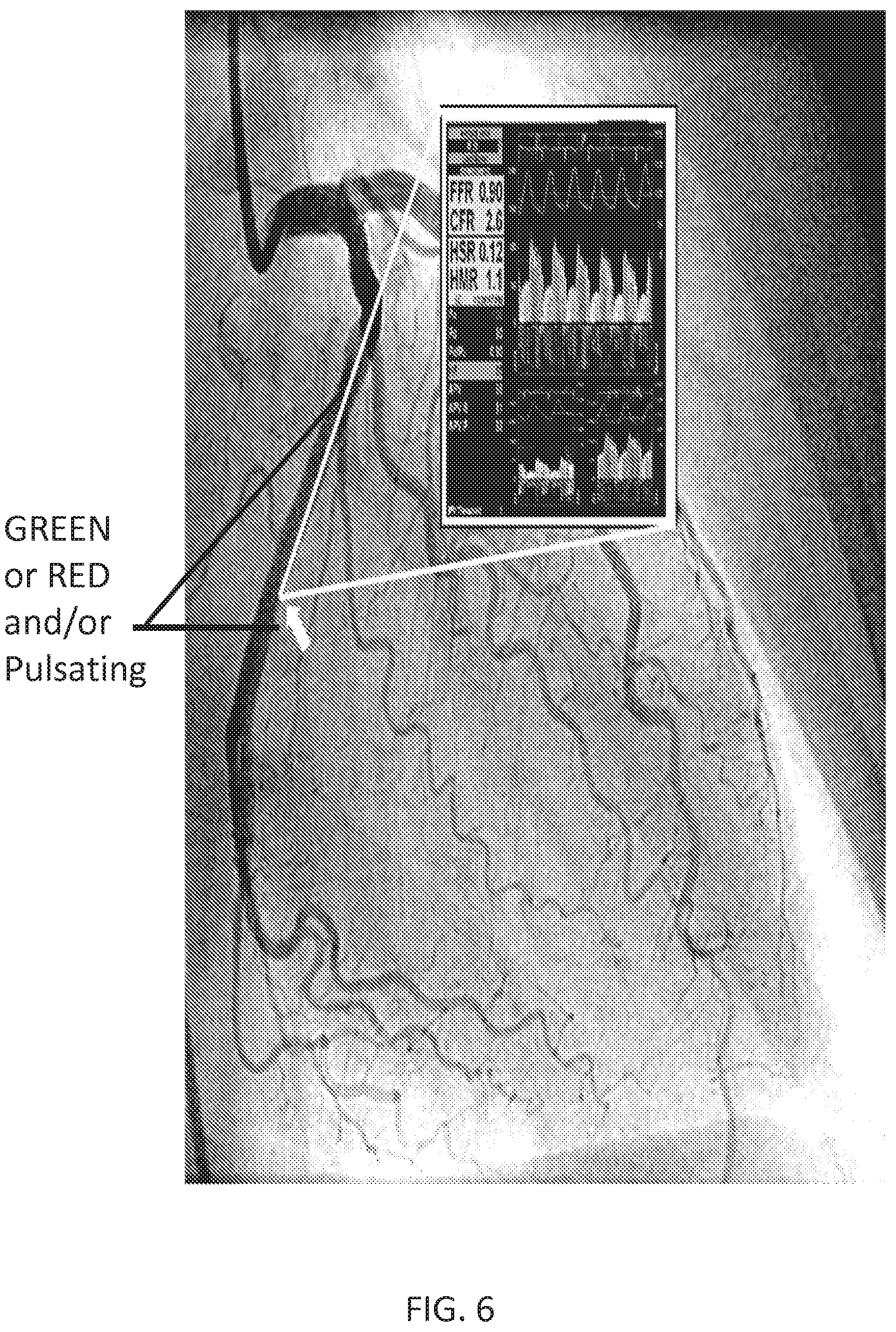 Patent US12350018 Figure 5 – Systems and methods for diagnosing coronary microvascular disease