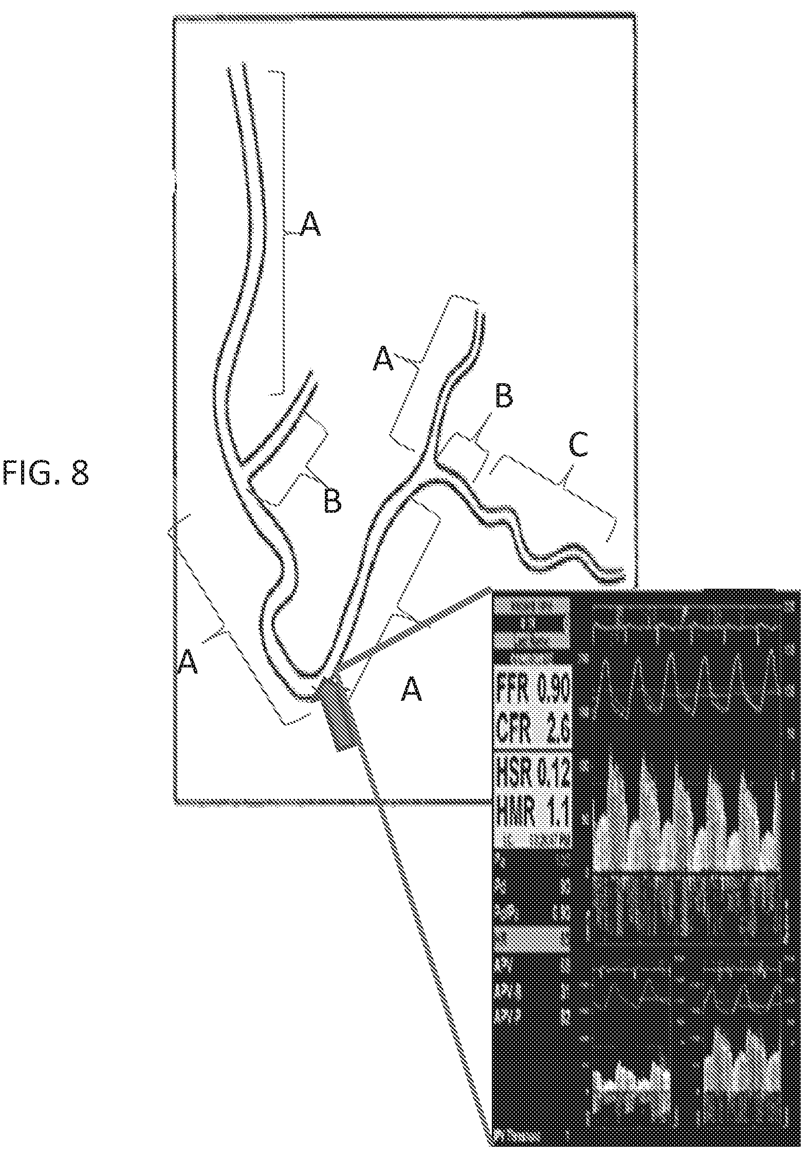 Patent US12350018 Figure 7 – Systems and methods for diagnosing coronary microvascular disease