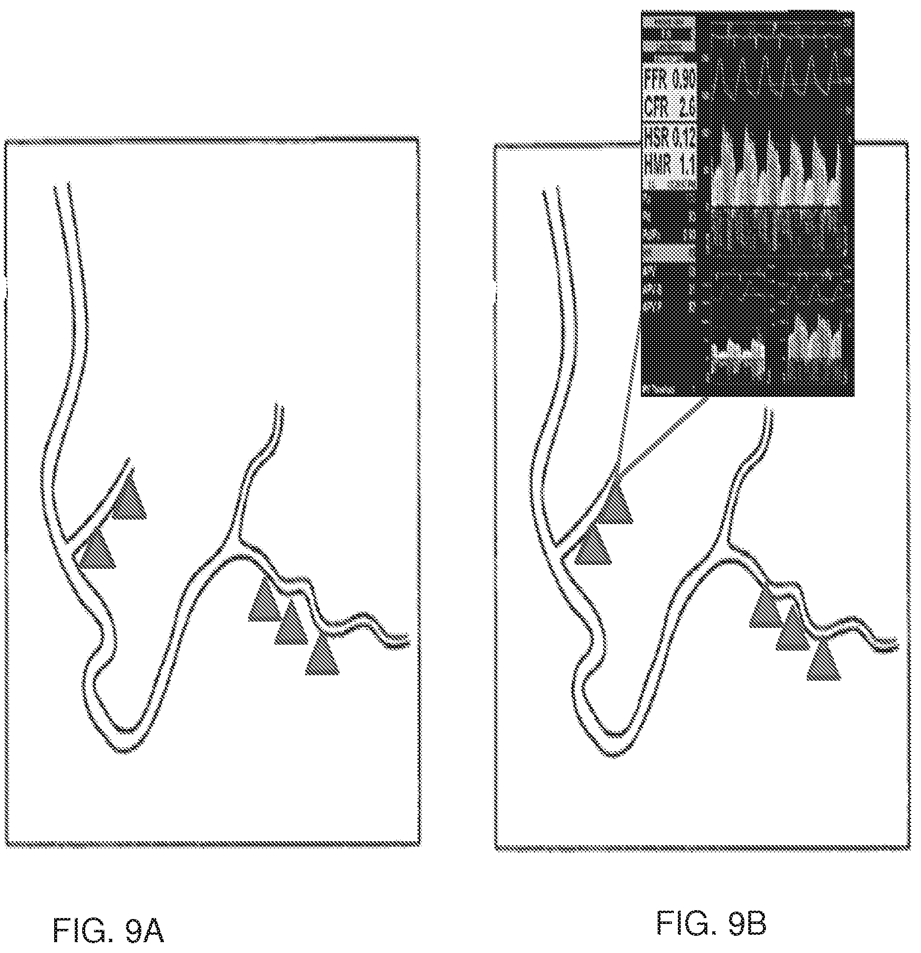 Patent US12350018 Figure 8 – Systems and methods for diagnosing coronary microvascular disease