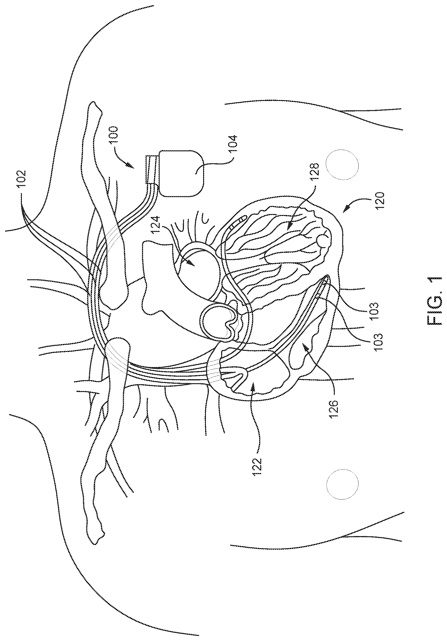 Patent US12350021 Figure 1 – Non-barometric determination of hemodynamic effects of cardiac arrhythmias using signals sensed by an implantable device