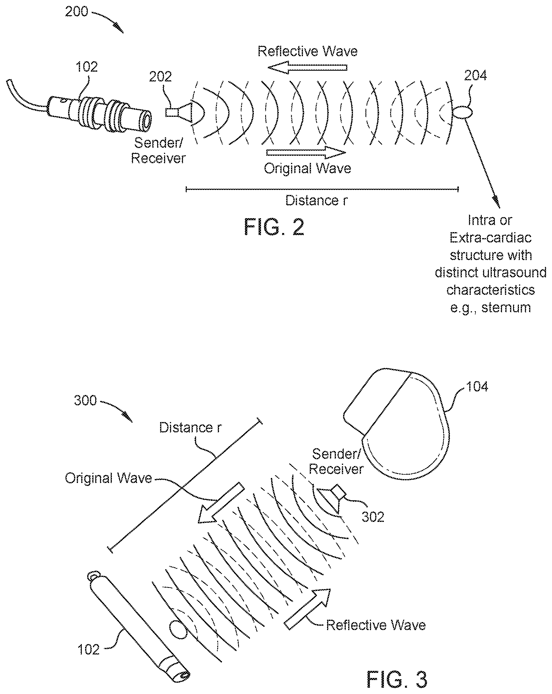 Patent US12350021 Figure 2 – Non-barometric determination of hemodynamic effects of cardiac arrhythmias using signals sensed by an implantable device